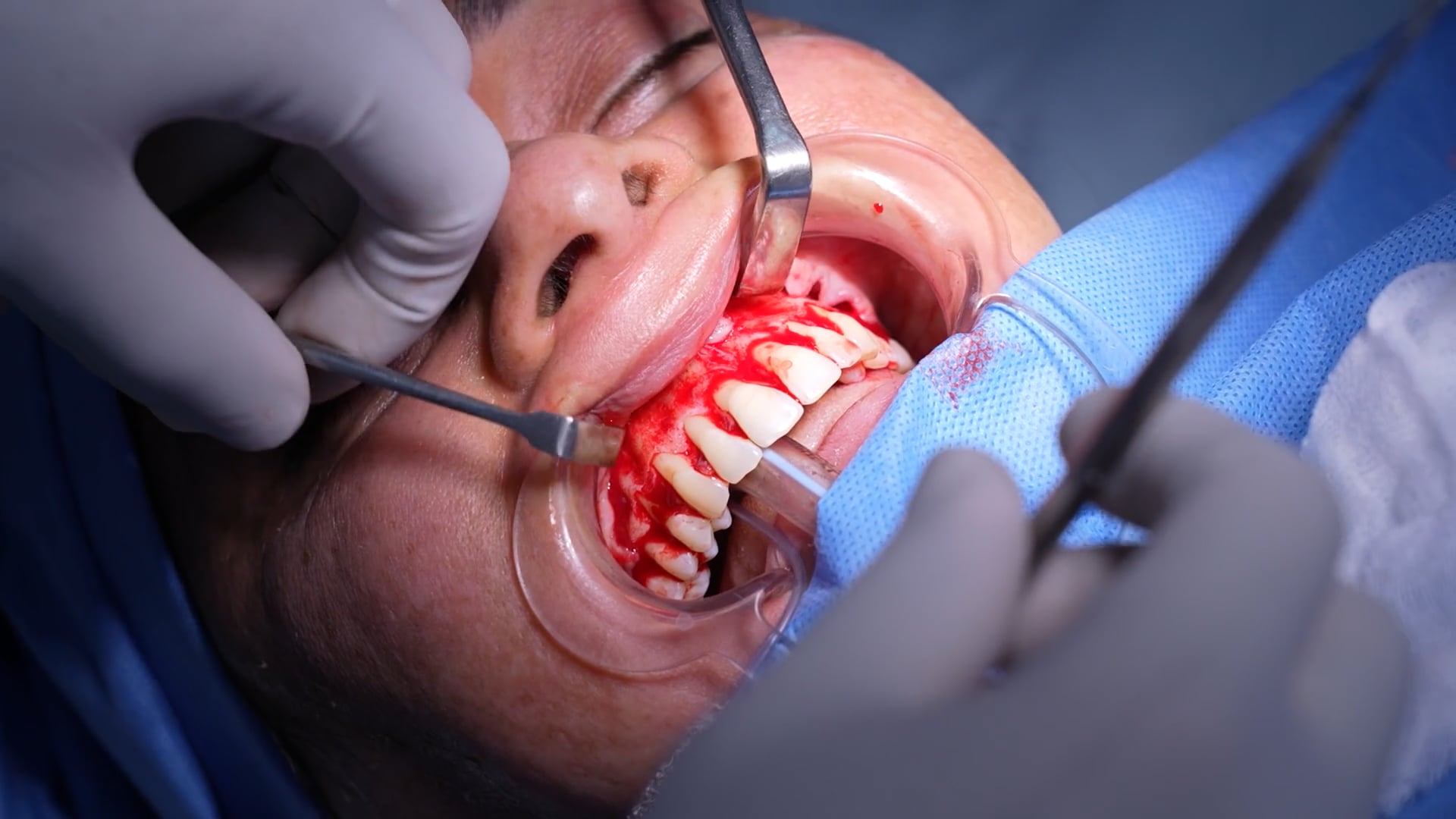 Teeth Gums Removal