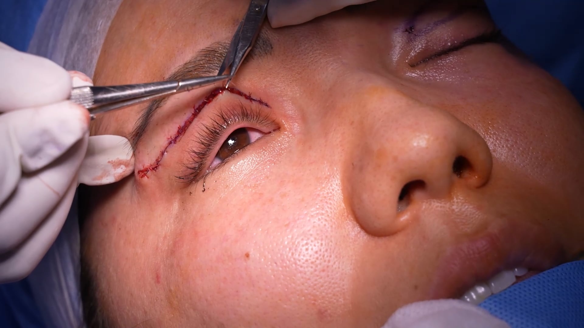 Upper Blepharoplasty Surgery
