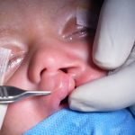 Cheliorhinoplasty surgery- Variant of Millard technique