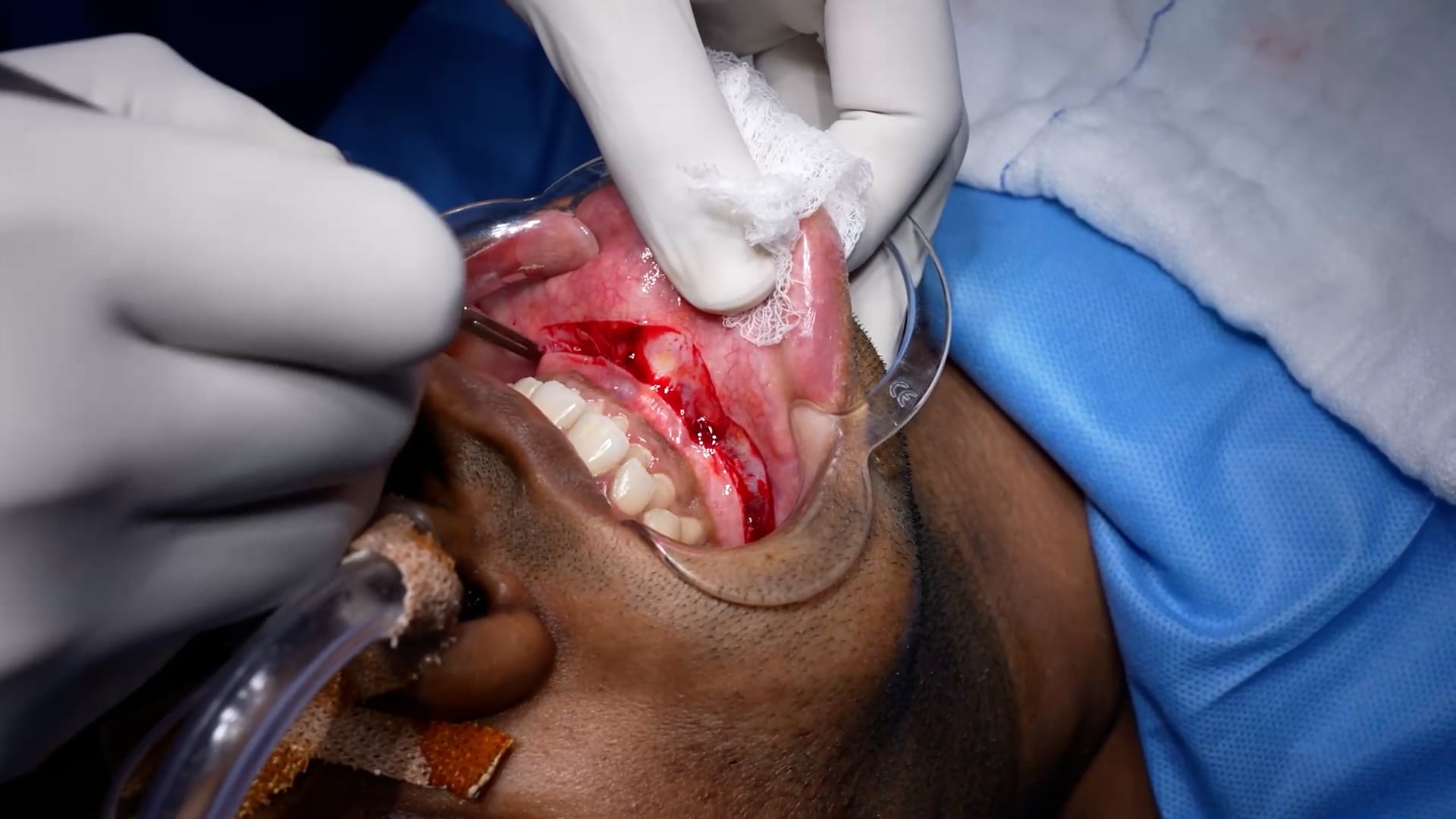 Retruded chin correction surgery