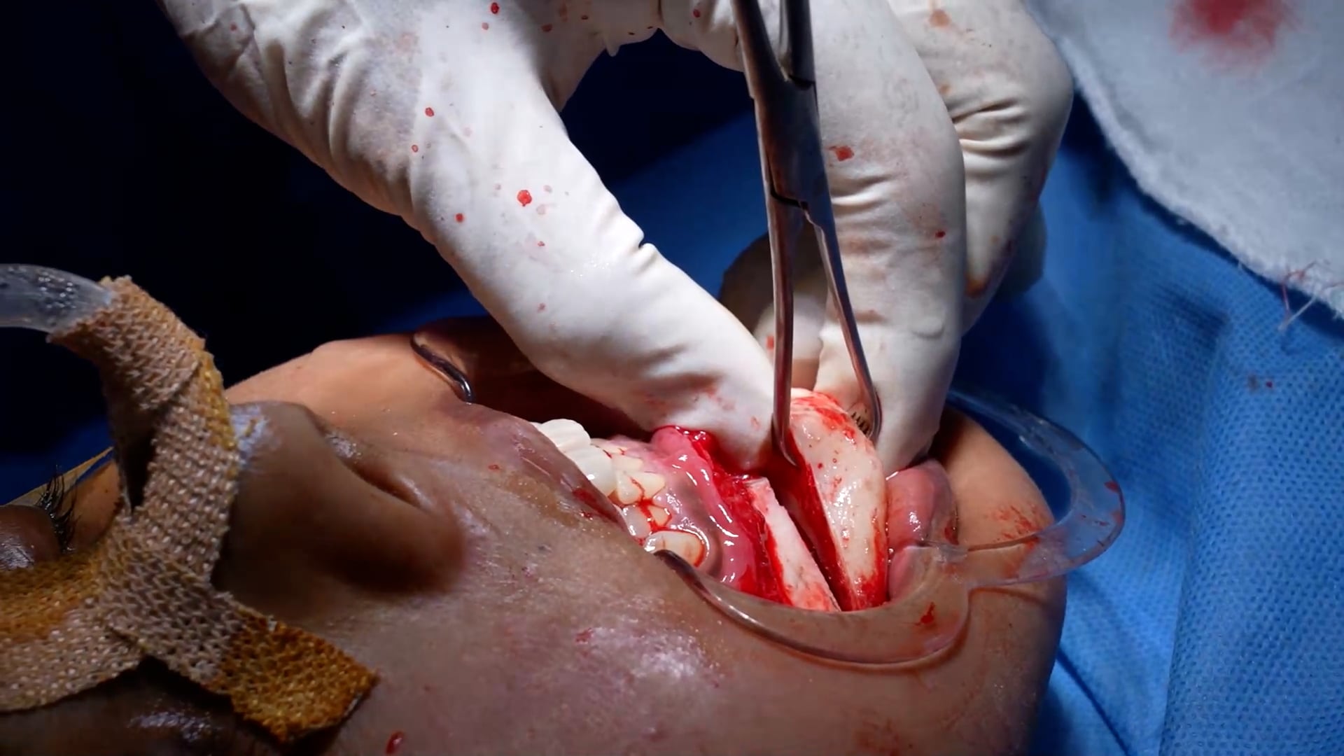 Masseter reduction, Genioplasty and Jaw sculpting
