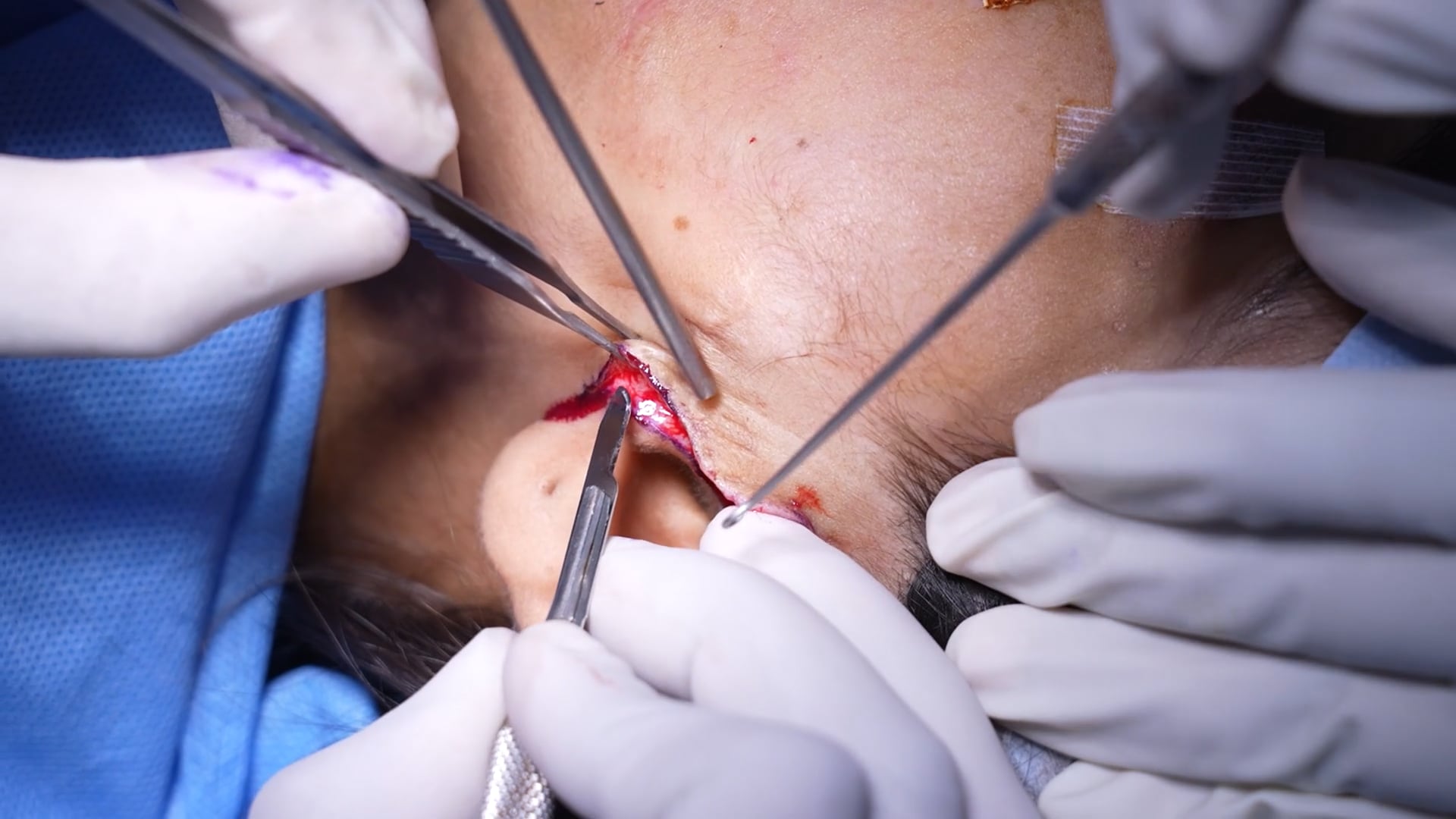 Skin Tightening