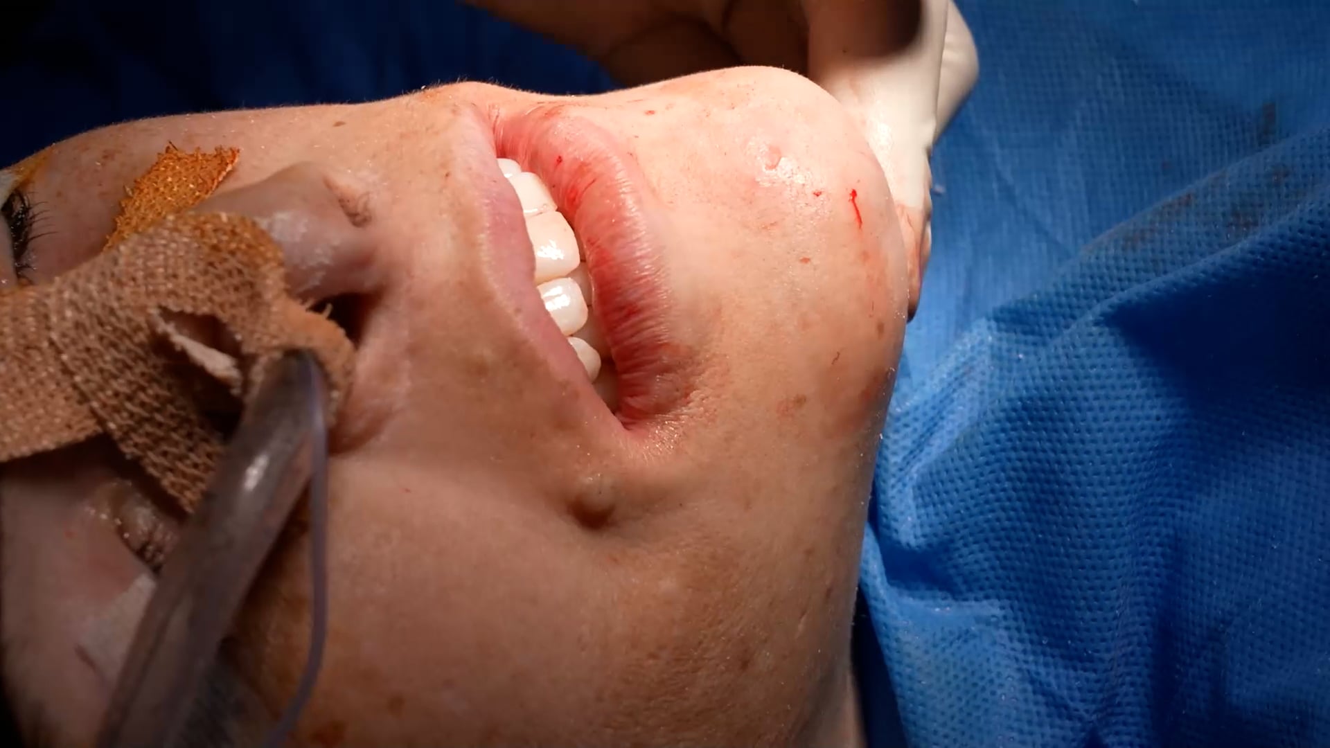 Revision Chin Augmentation and Mole Removal Surgery
