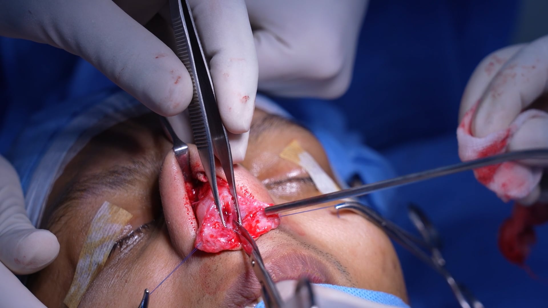 Rhinoplasty