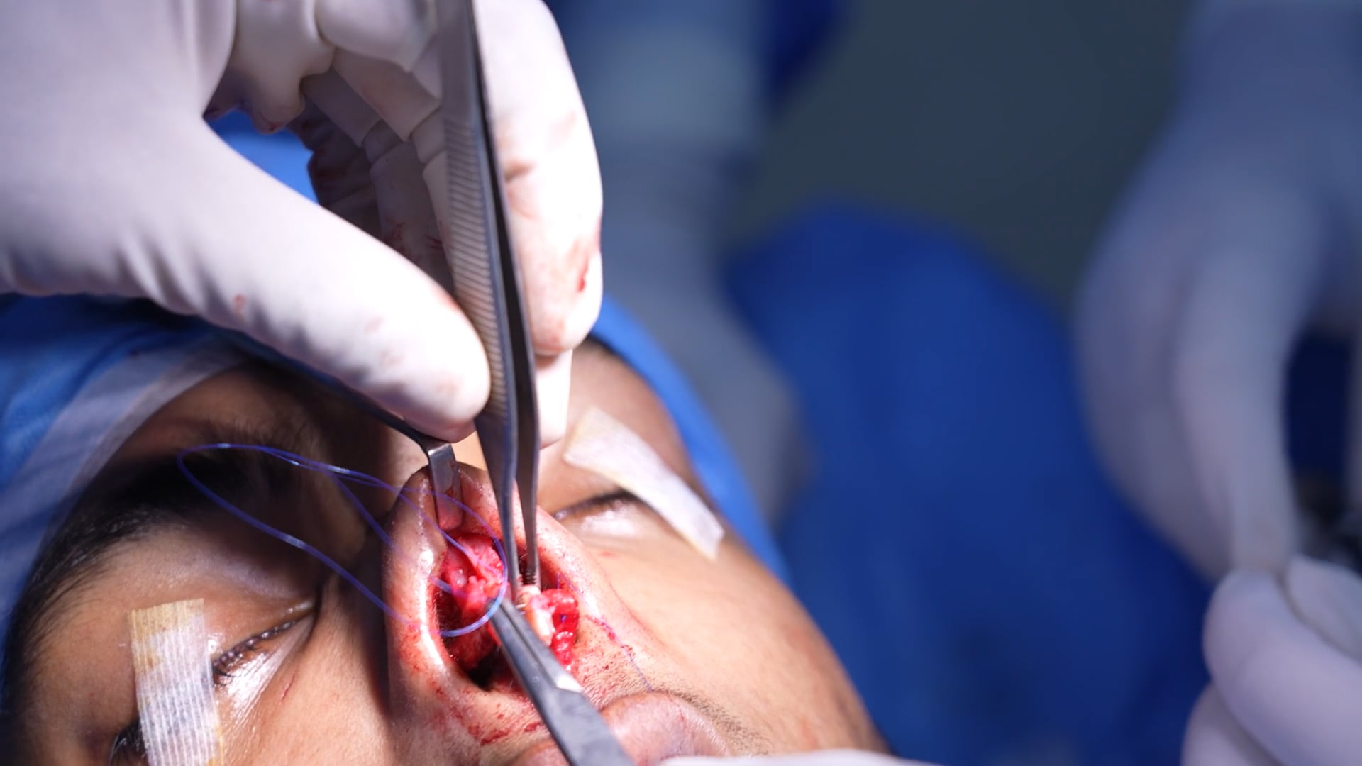 Rhinoplasty Male