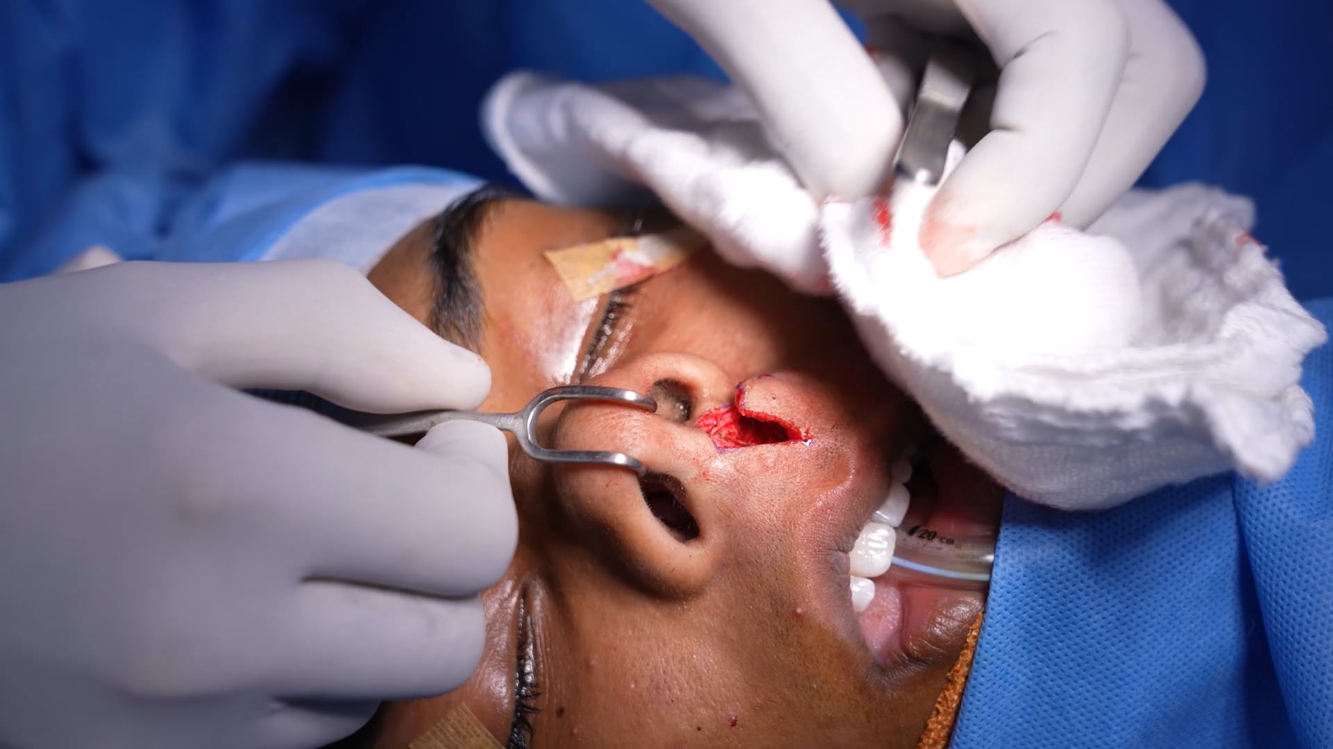 Rhinoplasty and Lip reduction