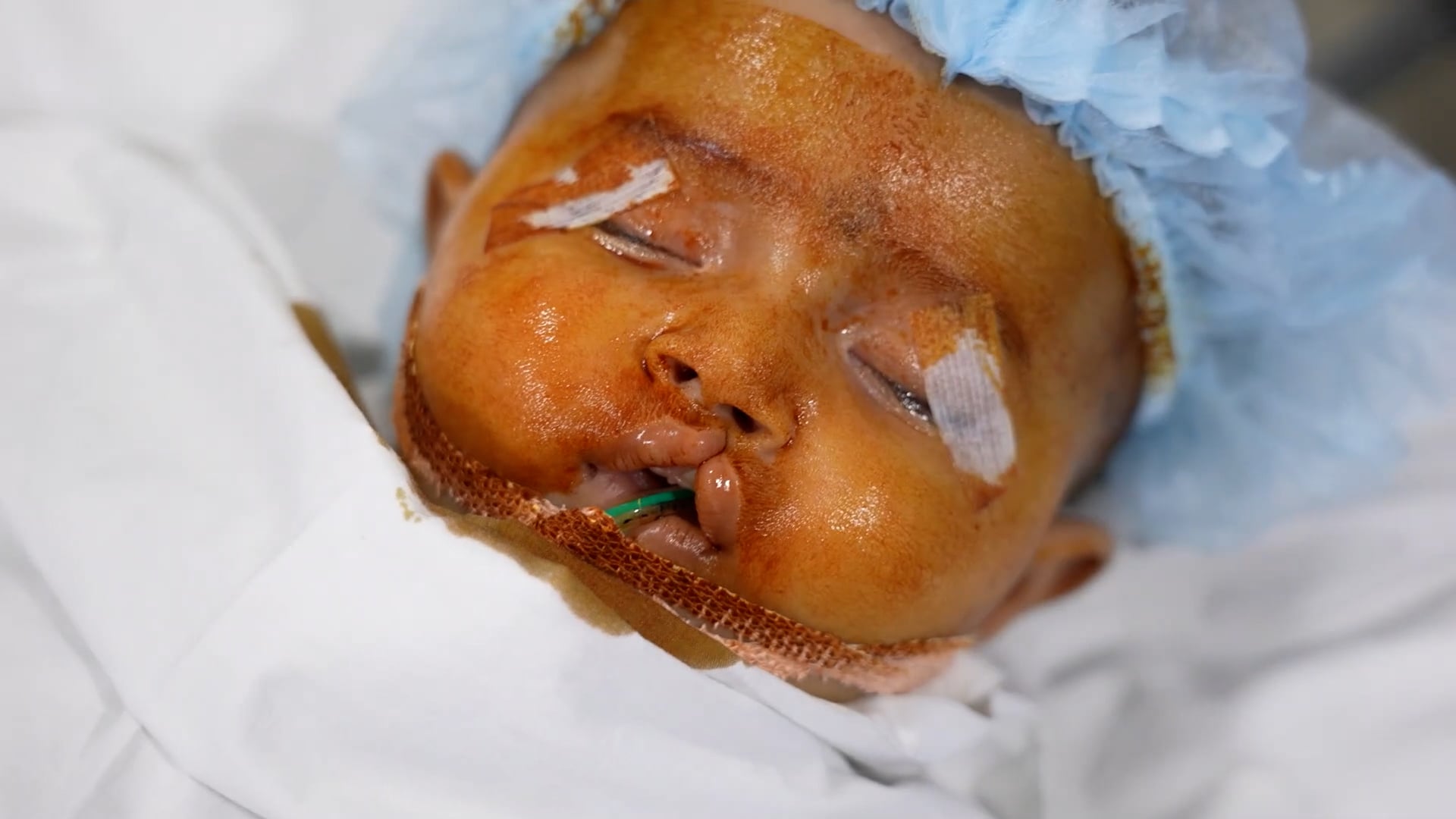Cleft Lip Complete Surgery