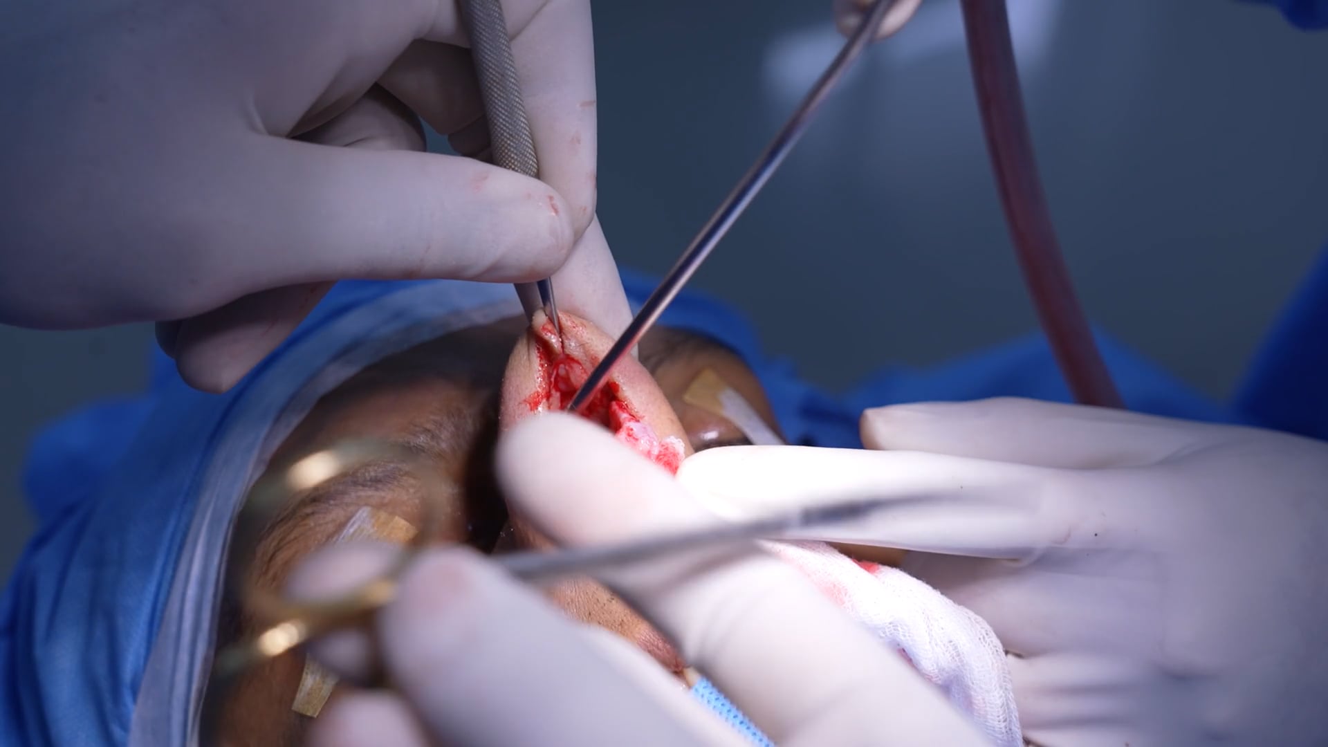 Rhinoplasty Young Man