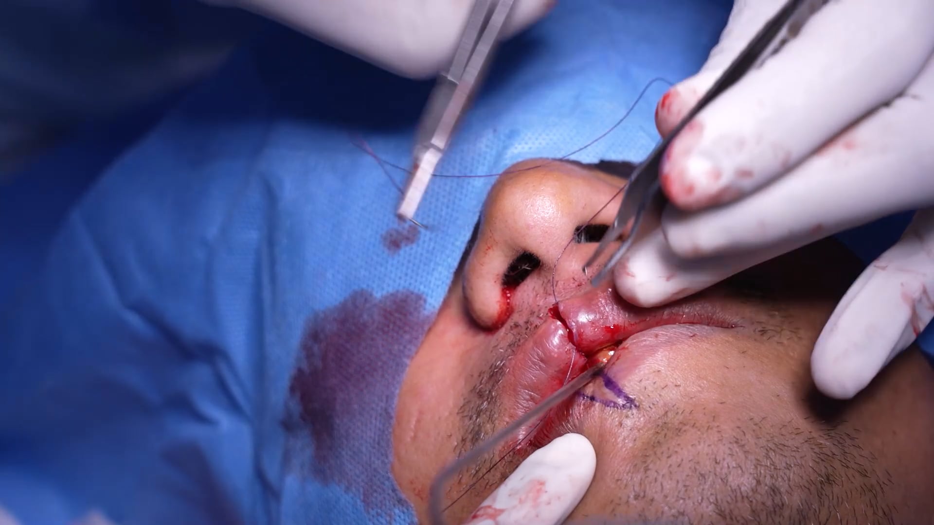 Lip reduction Male