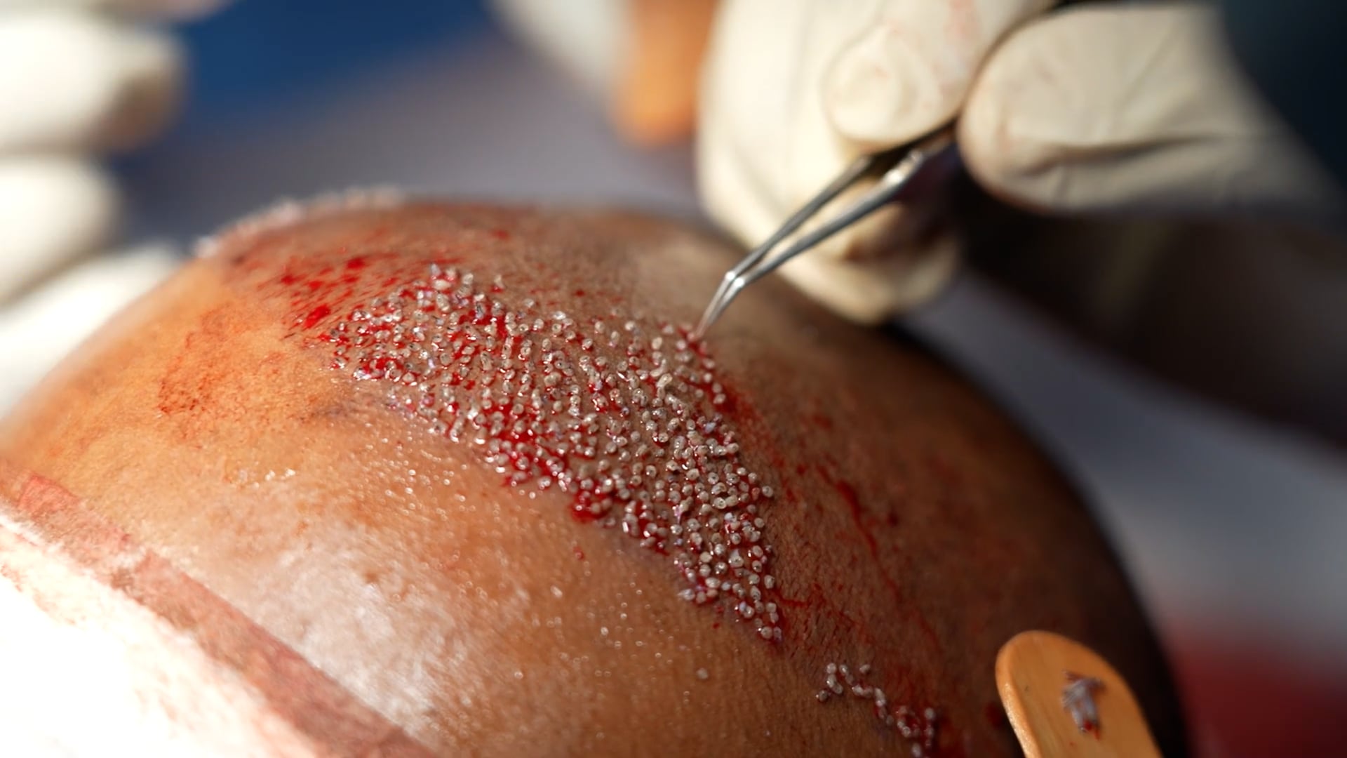 Hair Transplantation using FUE technique