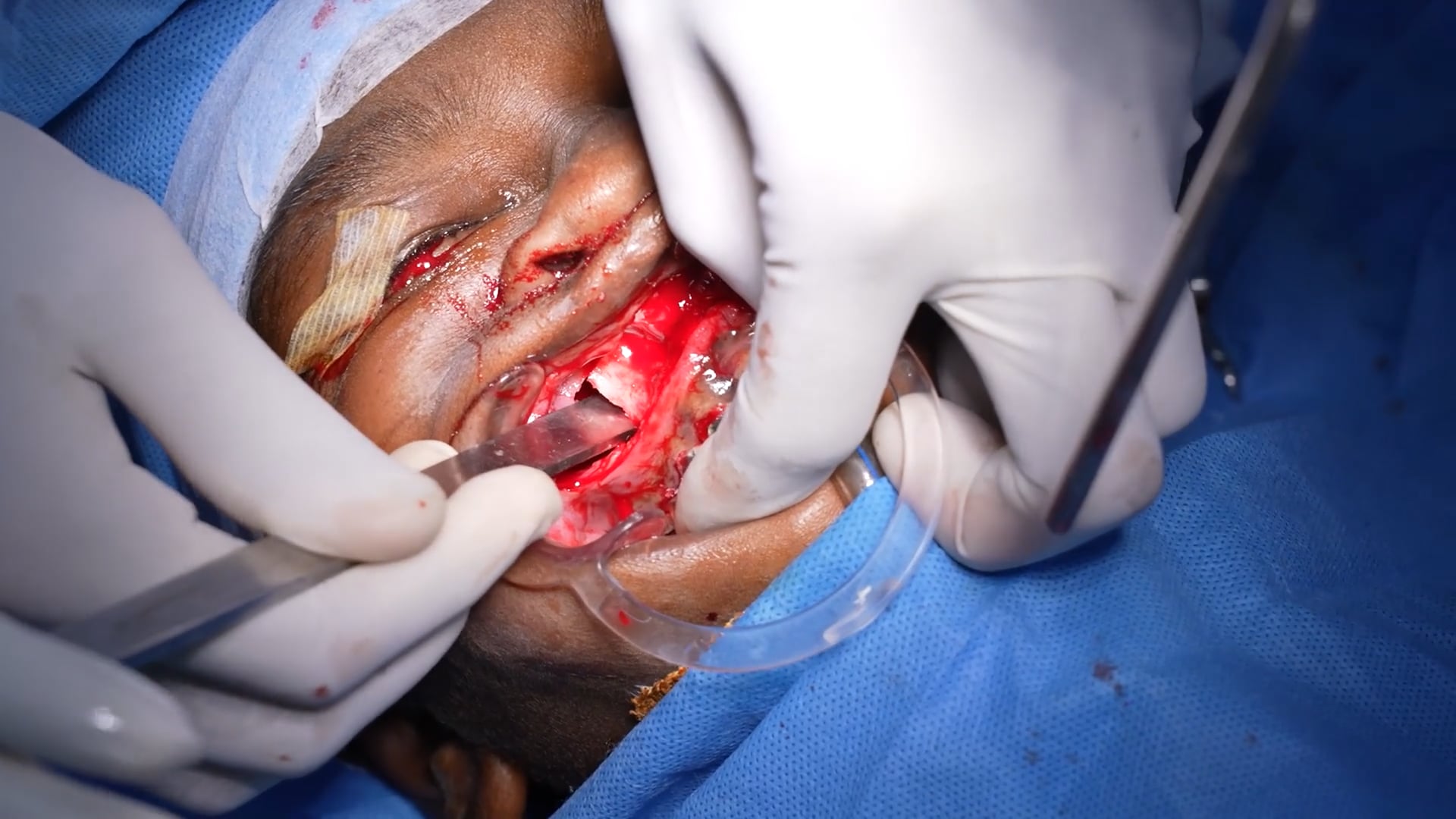 Anterior Maxillary Distraction