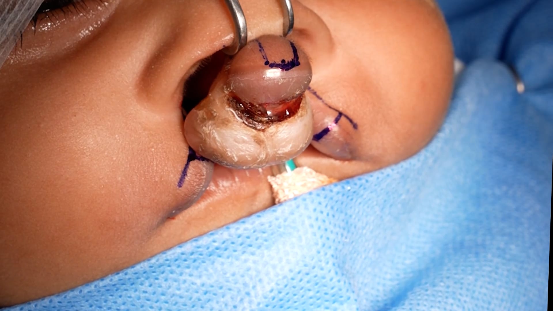 Bilateral cleft lip repair