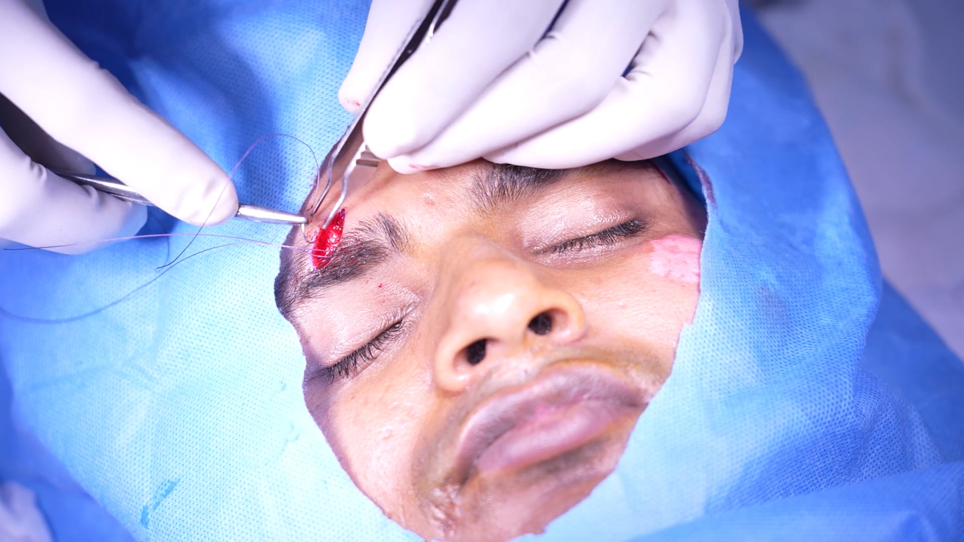 Scar Revision
