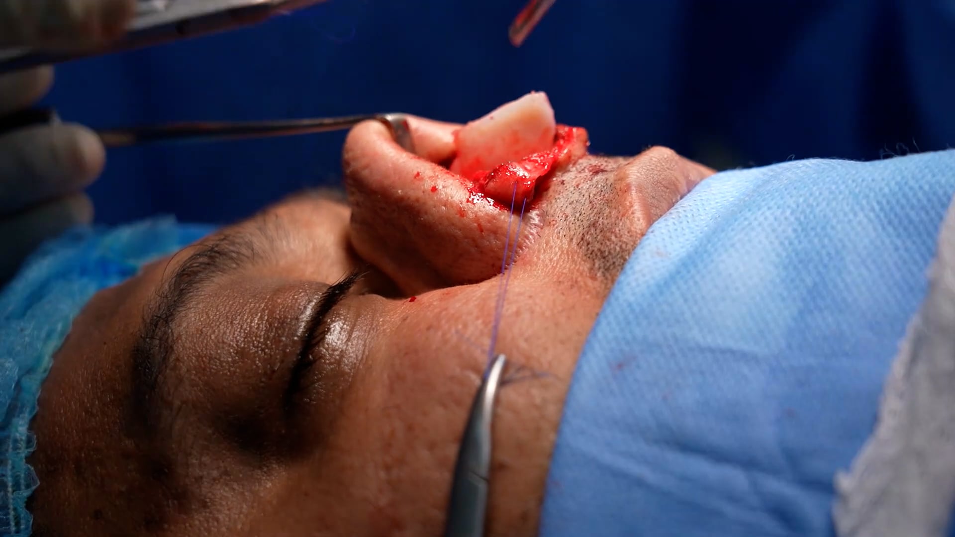 rhinoplasty
