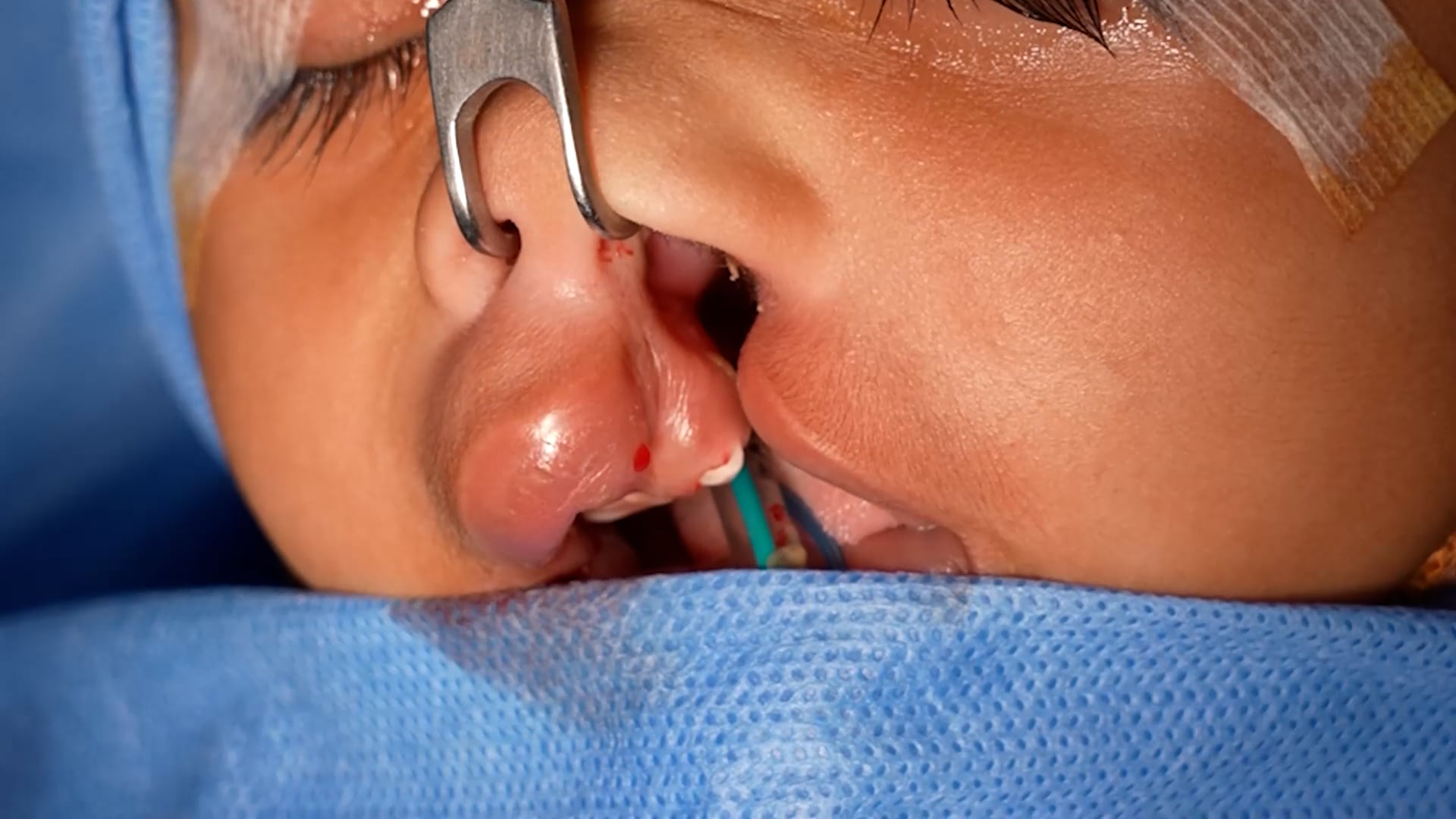 Chieloplasty for left complete wide cleft lip
