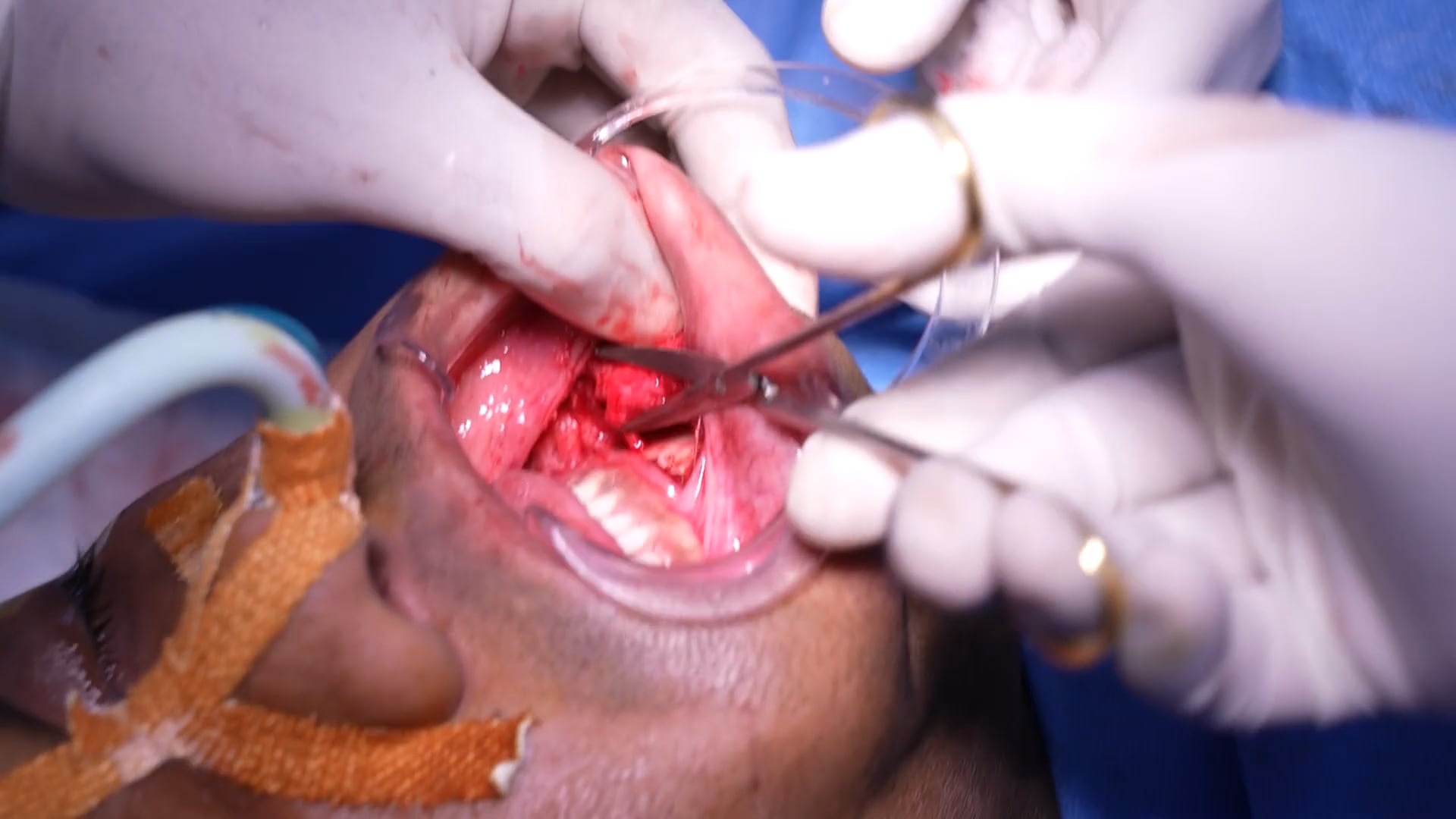 Revision Rhinoplasty