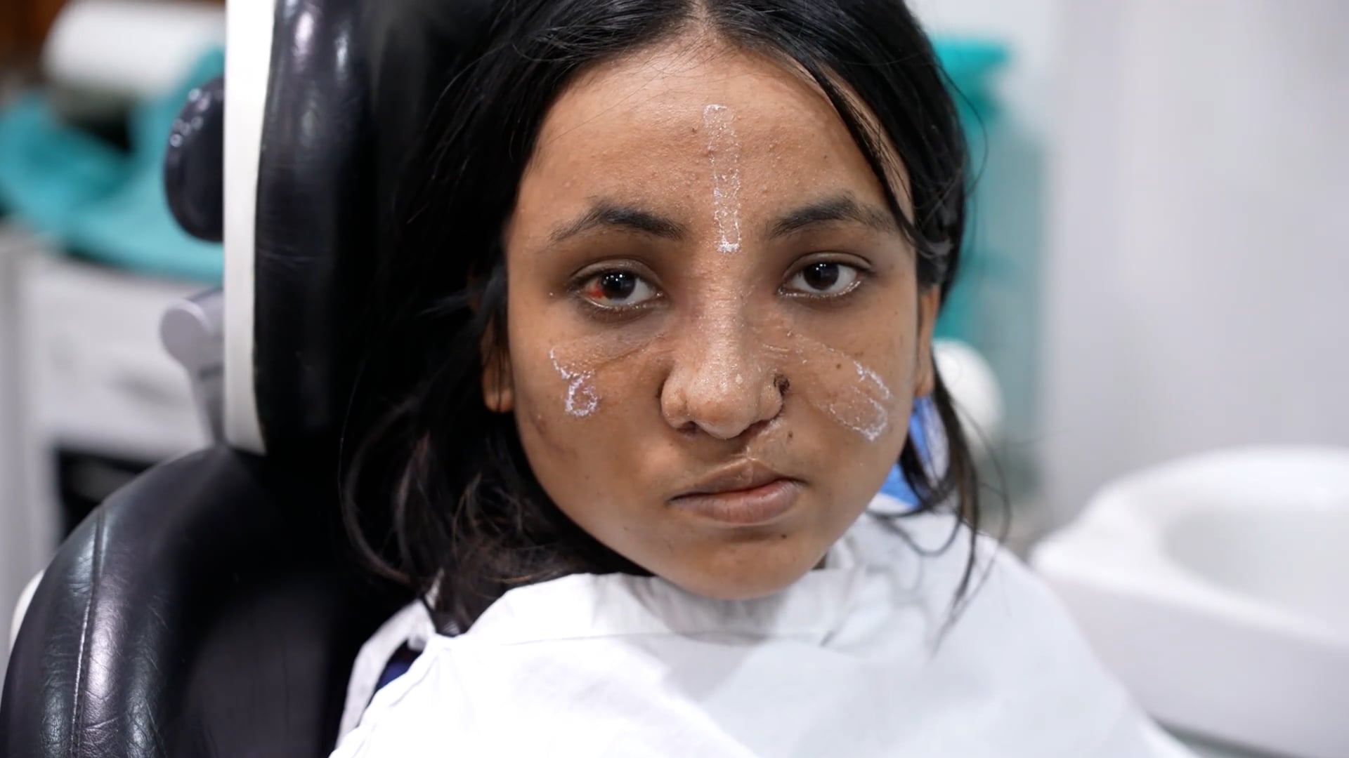 Girl Going under Cleft Rhinoplasty