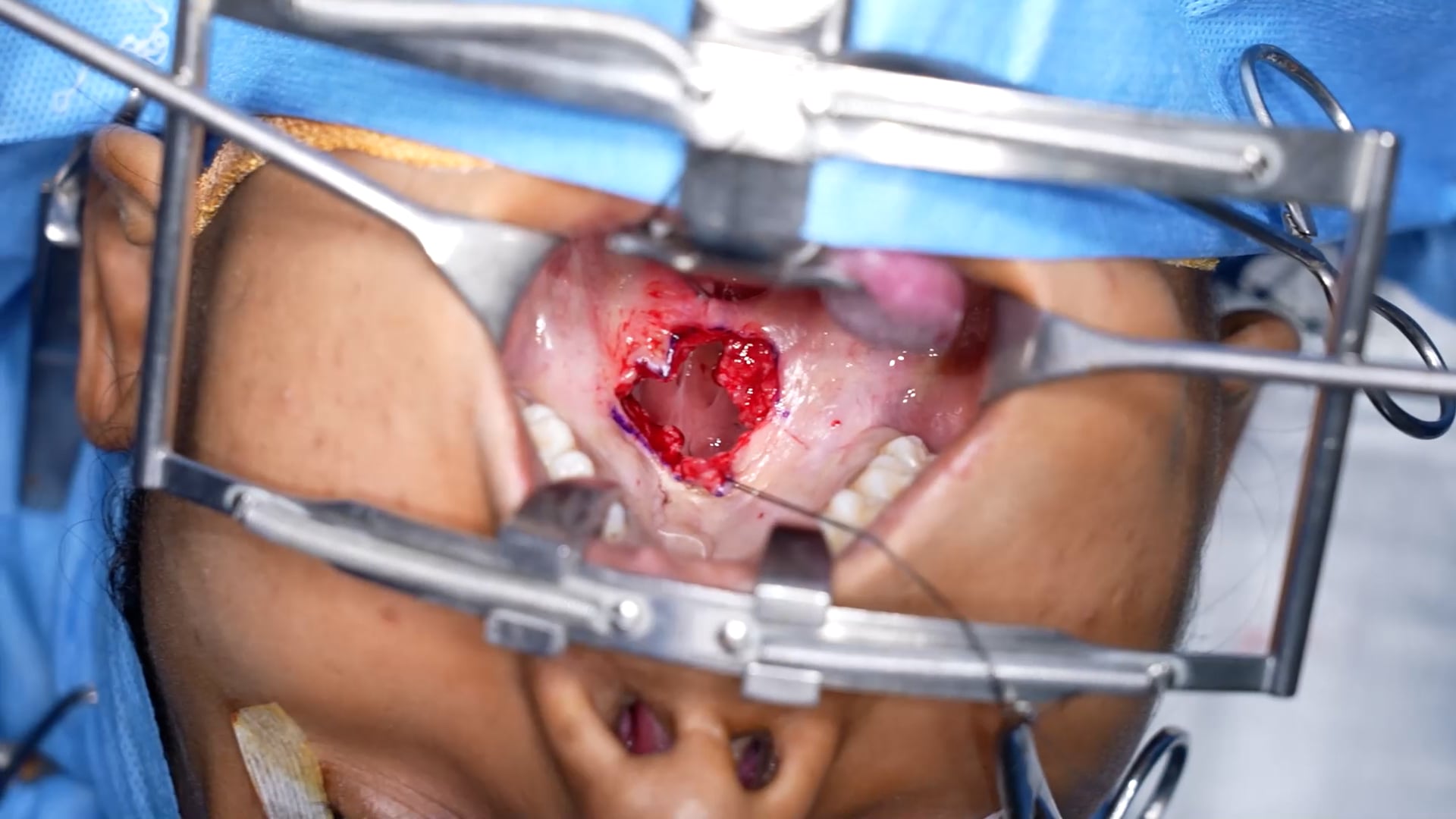 Furlow's Z plasty for Velopharyngeal