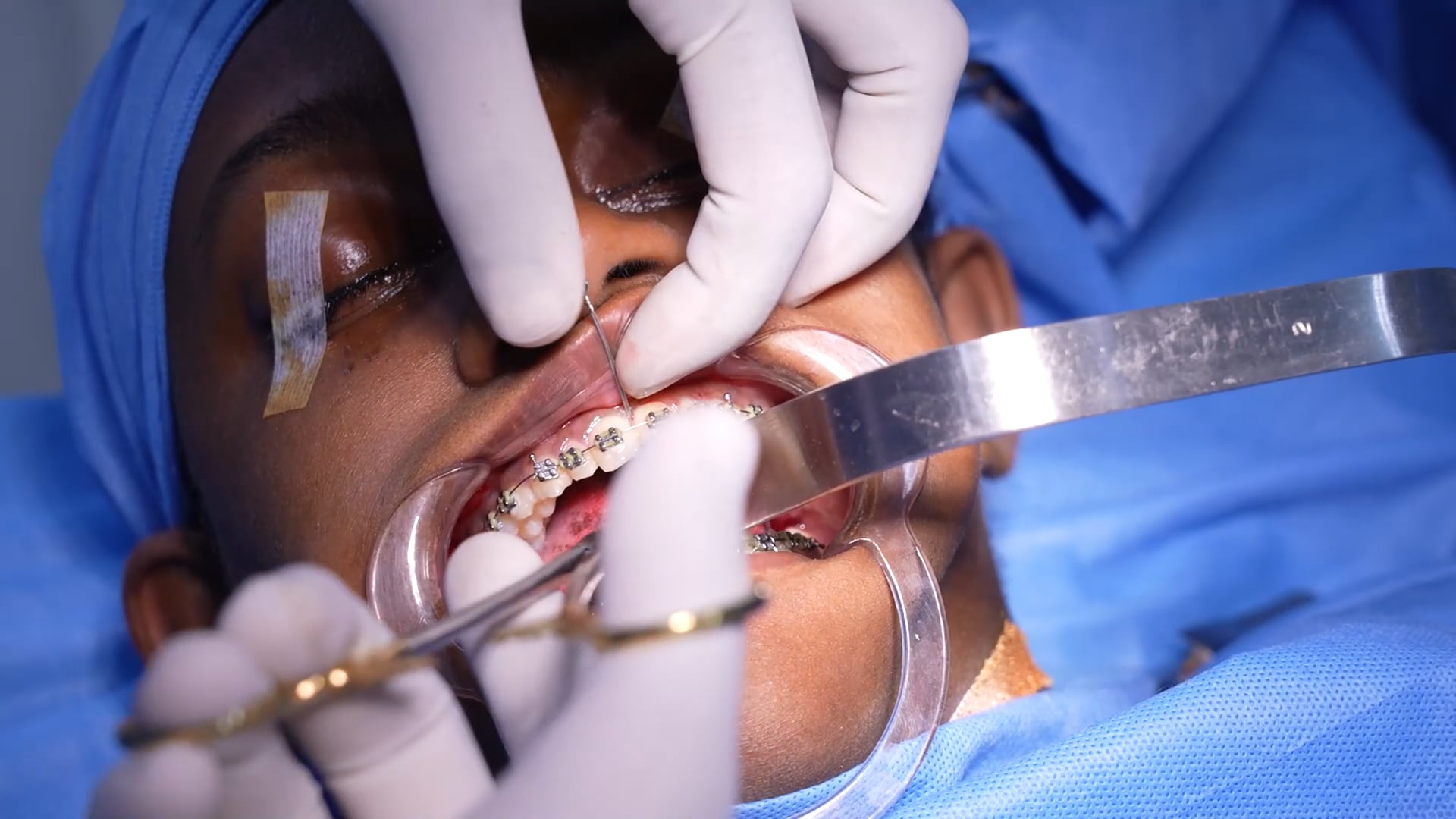 Young Girl Bijaw Surgery