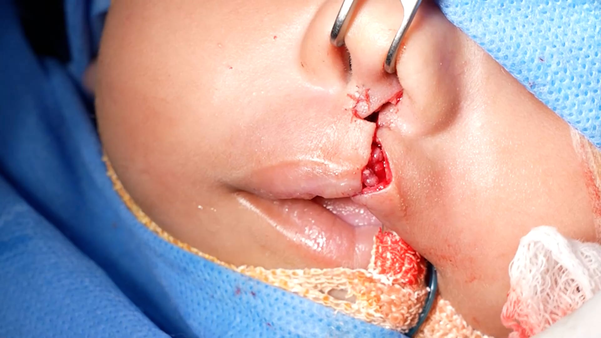 Cleft lip repair-Modified Millard technique