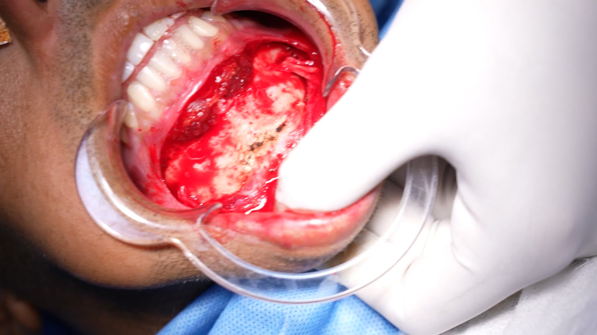 Chin augmentation Male