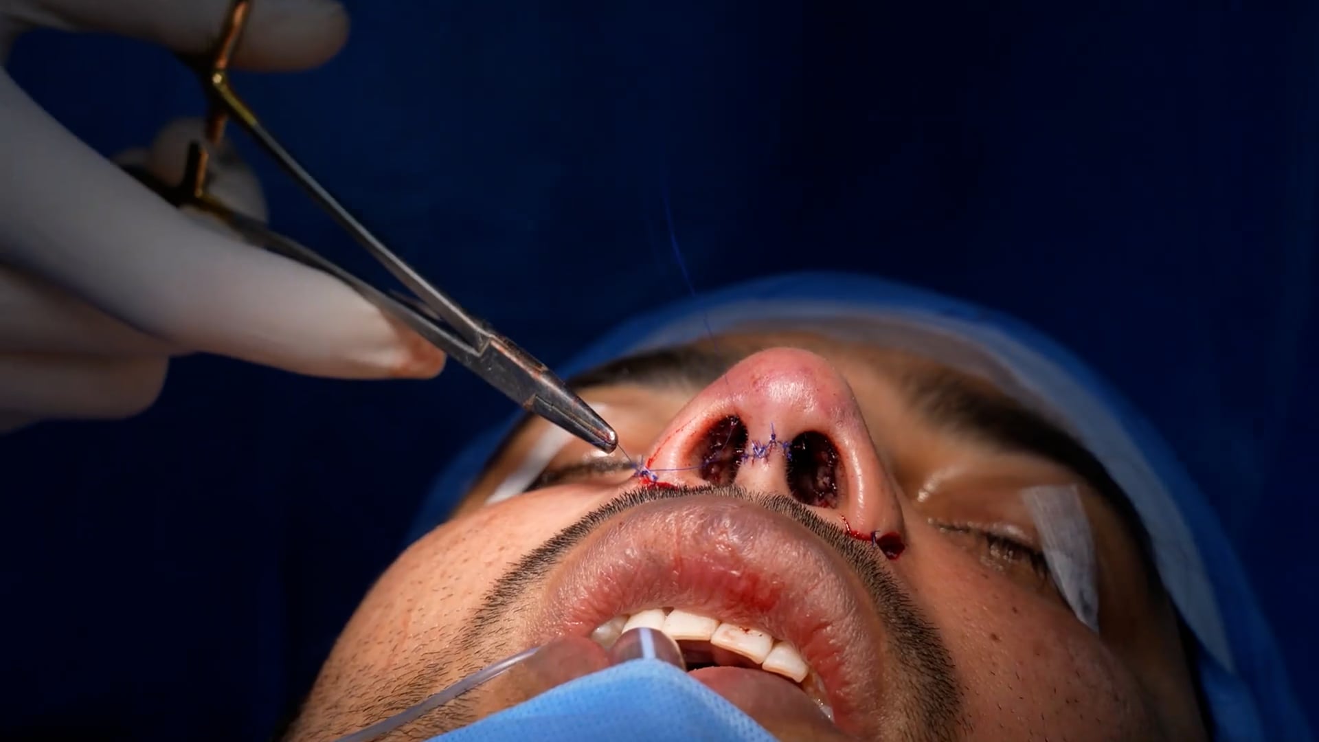 Flat and broad nose correction after trauma- Revision rhinoplasty