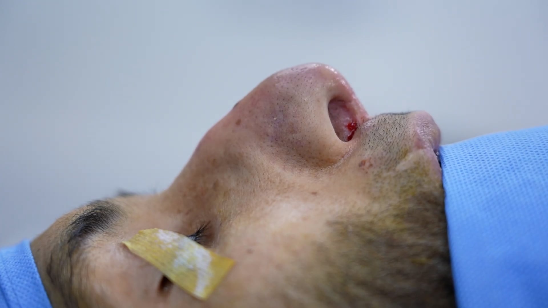 Revision rhinoplasty- Dorsal hump correction