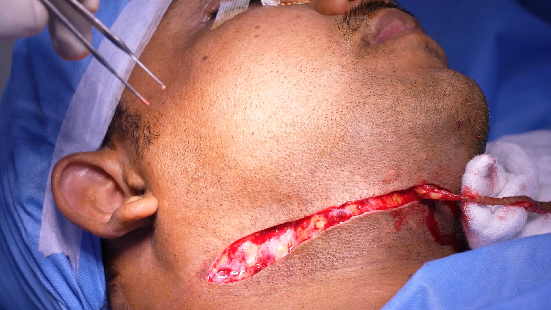 Scar Revision Augmentation