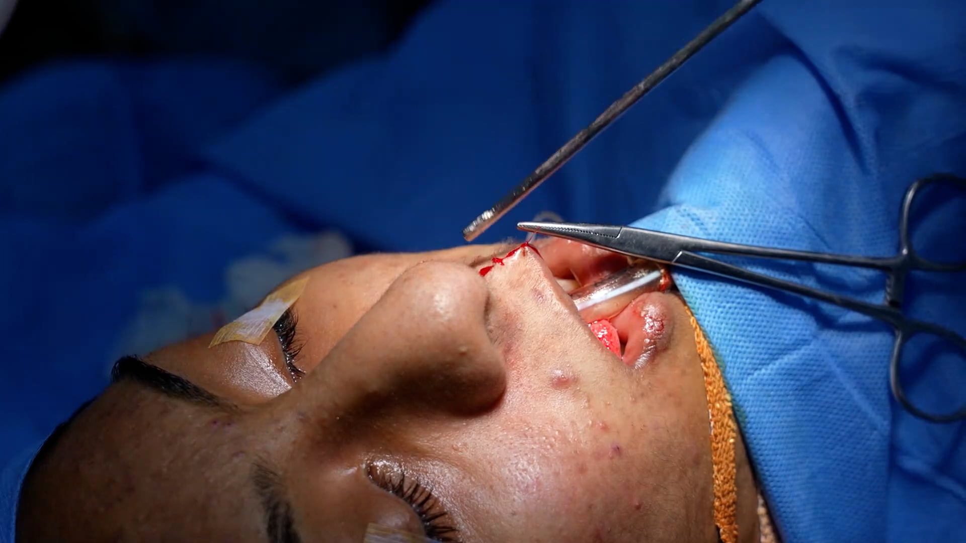 Revision rhinoplasty and lip repair surgery