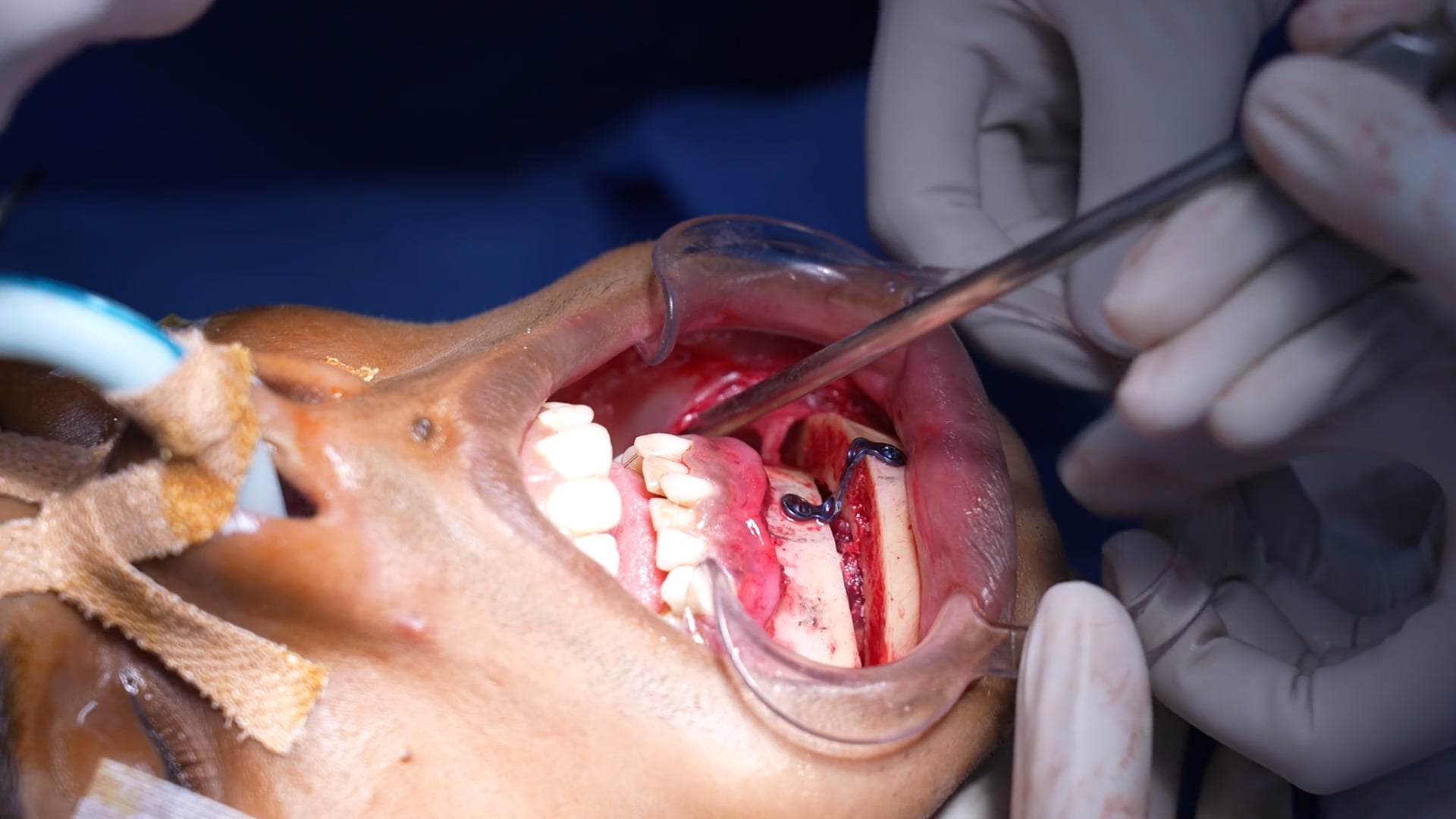 Chin Augmentation Surgery