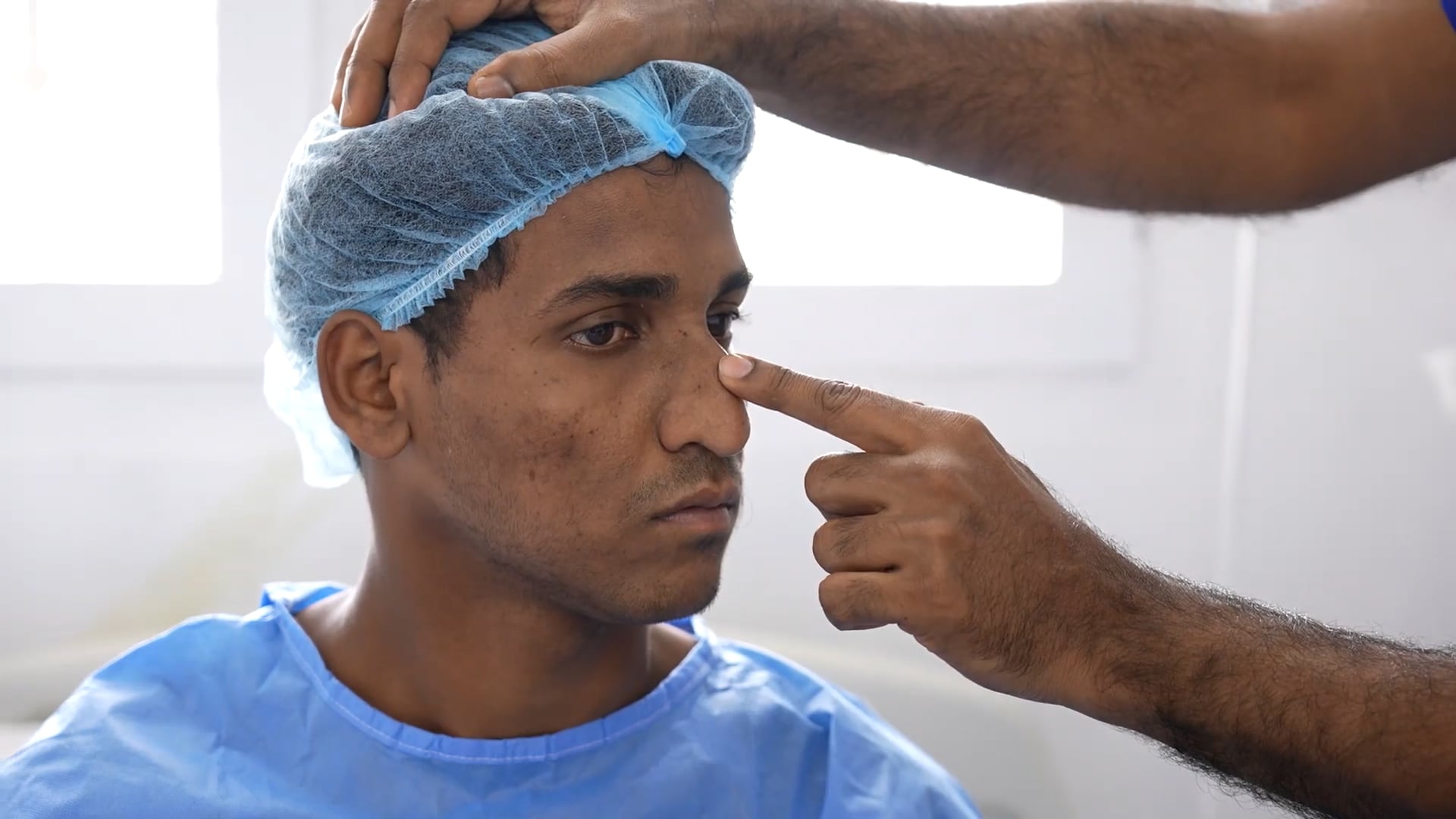 Beak Nose Correction- Septorhinoplasty