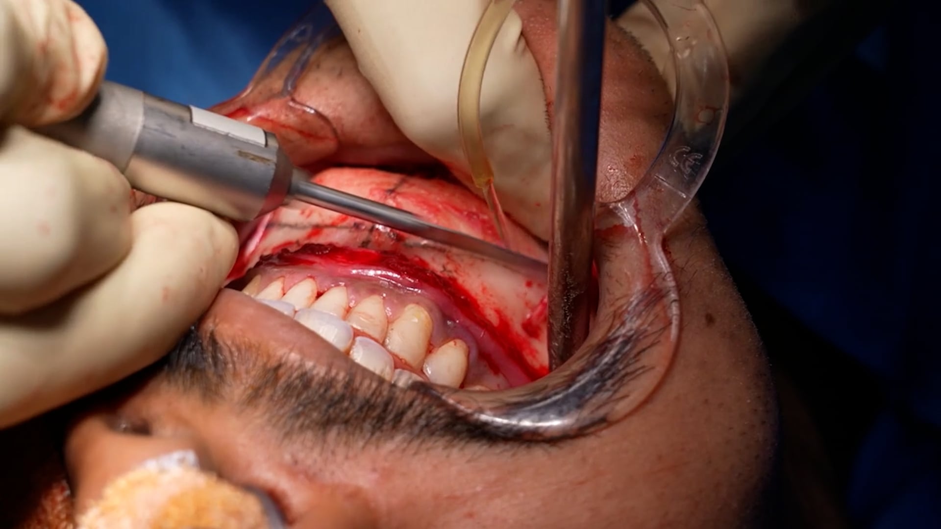 Stubby and short chin- Genioplasty and angle osteoplasty procedure