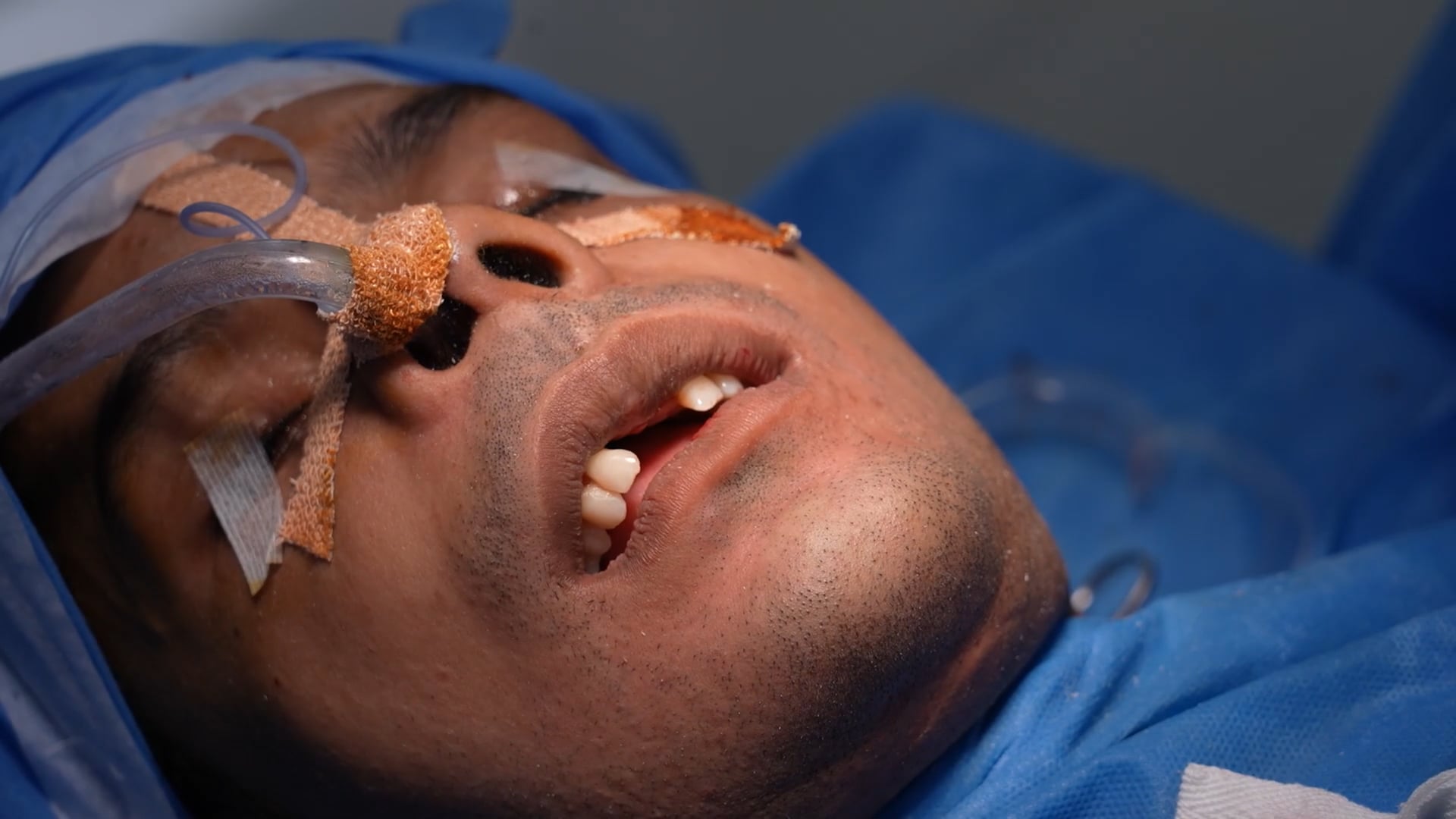 Genioplasty