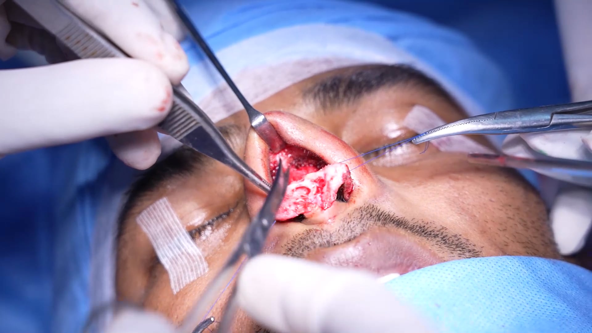 Young Man Rhinoplasty