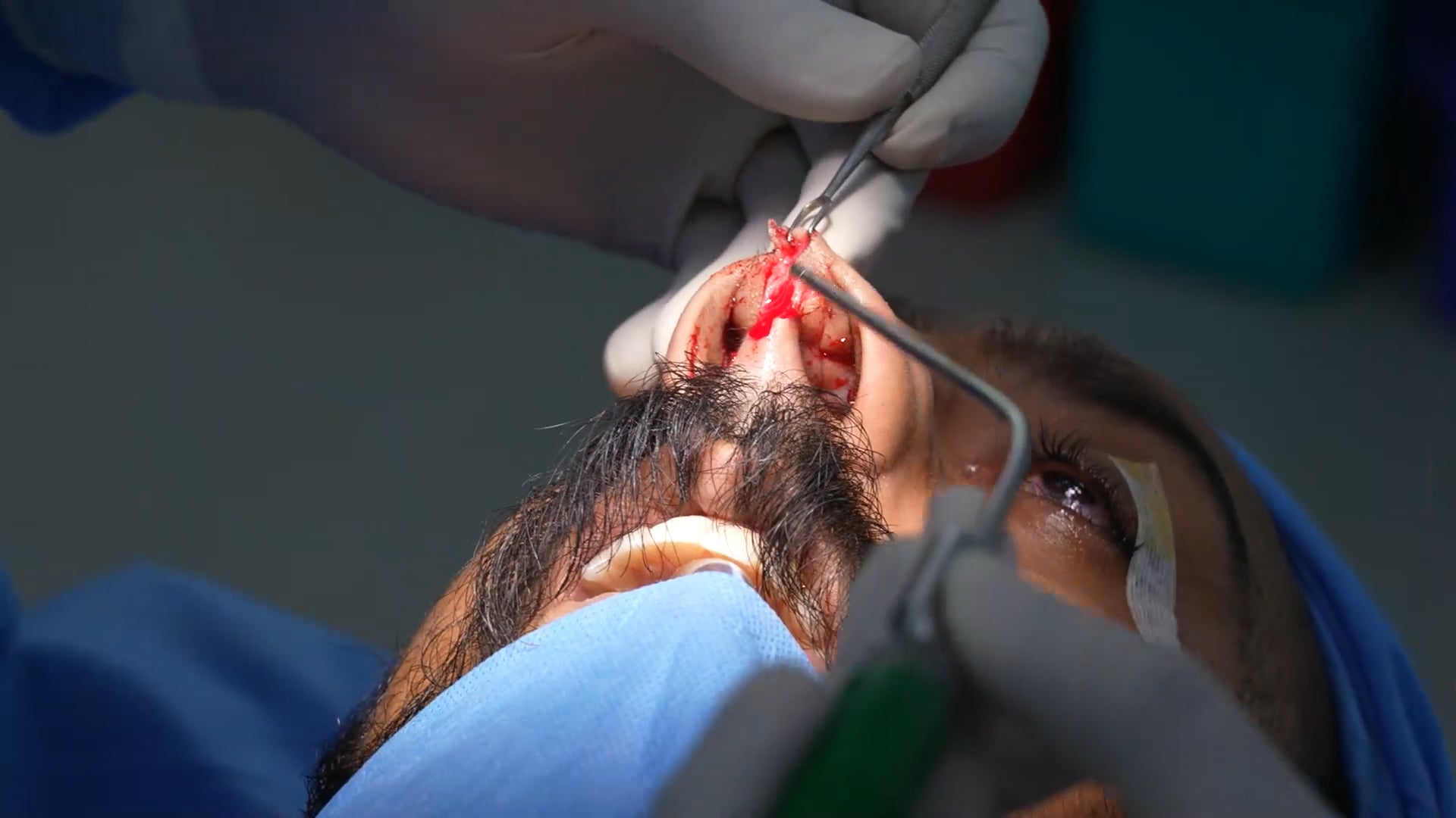 RHINOPLASTY
