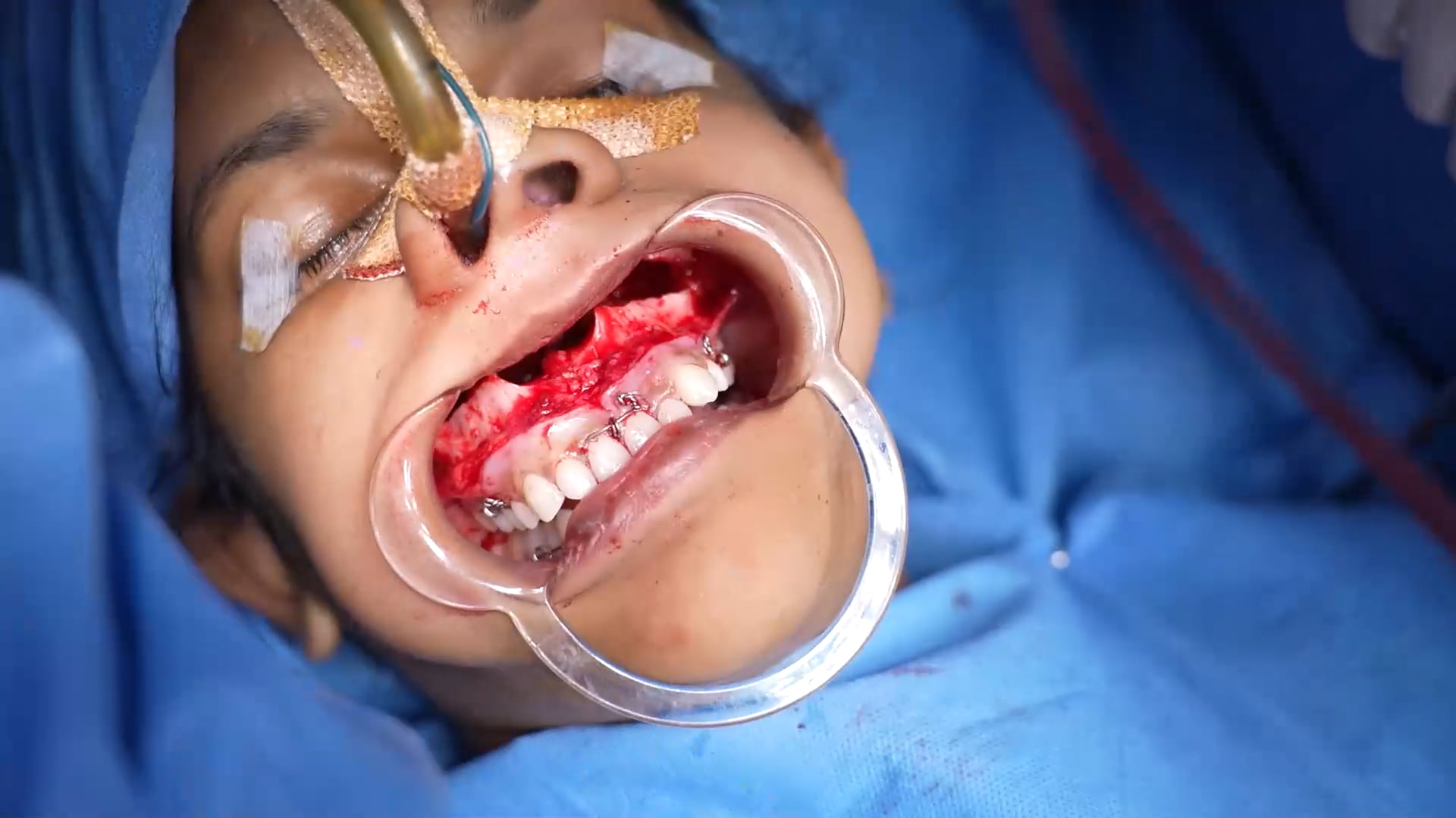 Maxillary Advancement Double Jaw Surgery