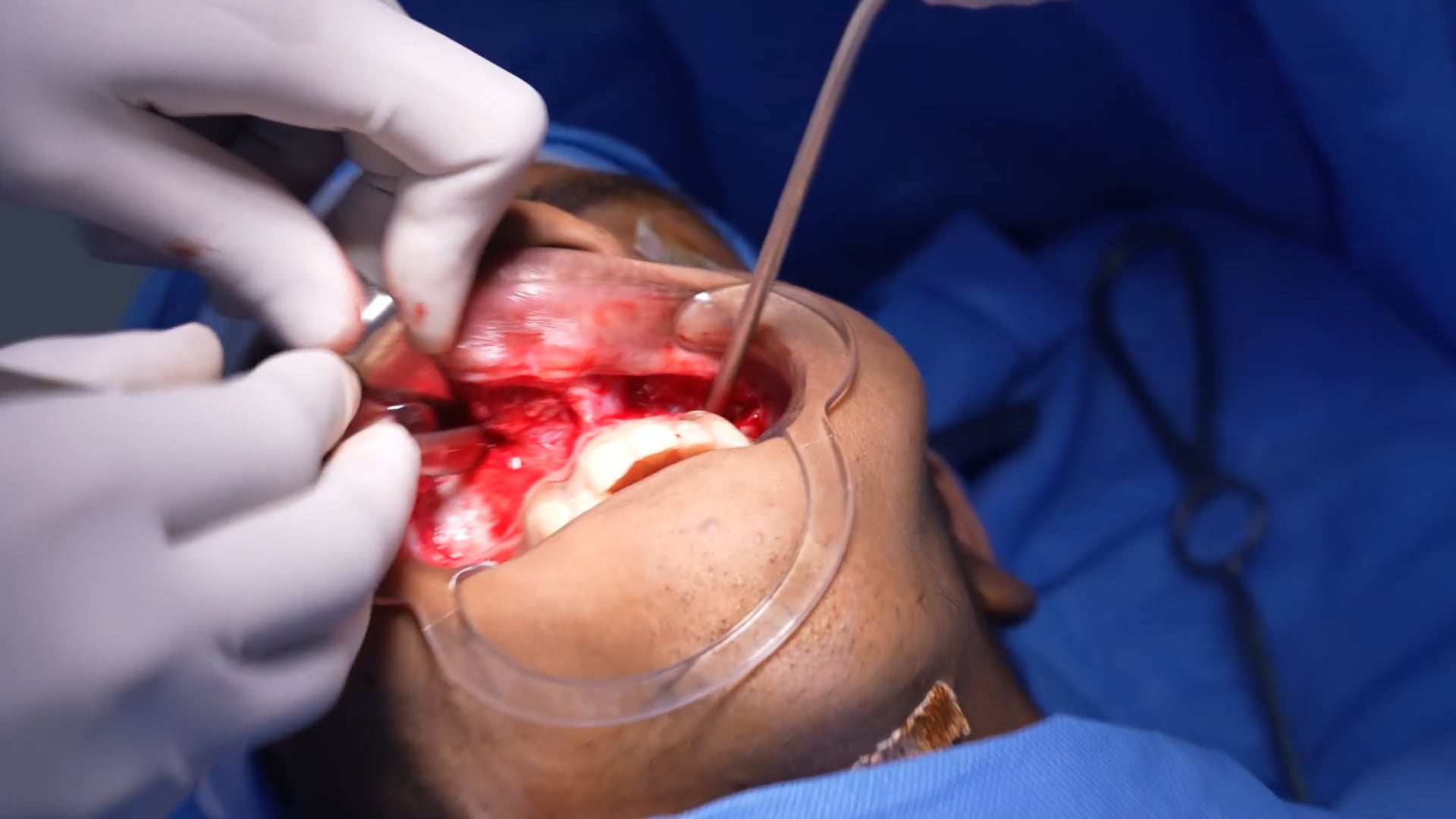 Young Man Bijaw Surgery