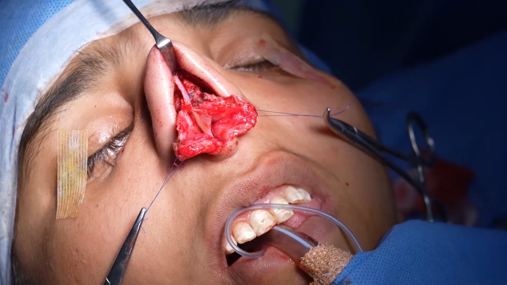 Female Rhinoplasty Surgery