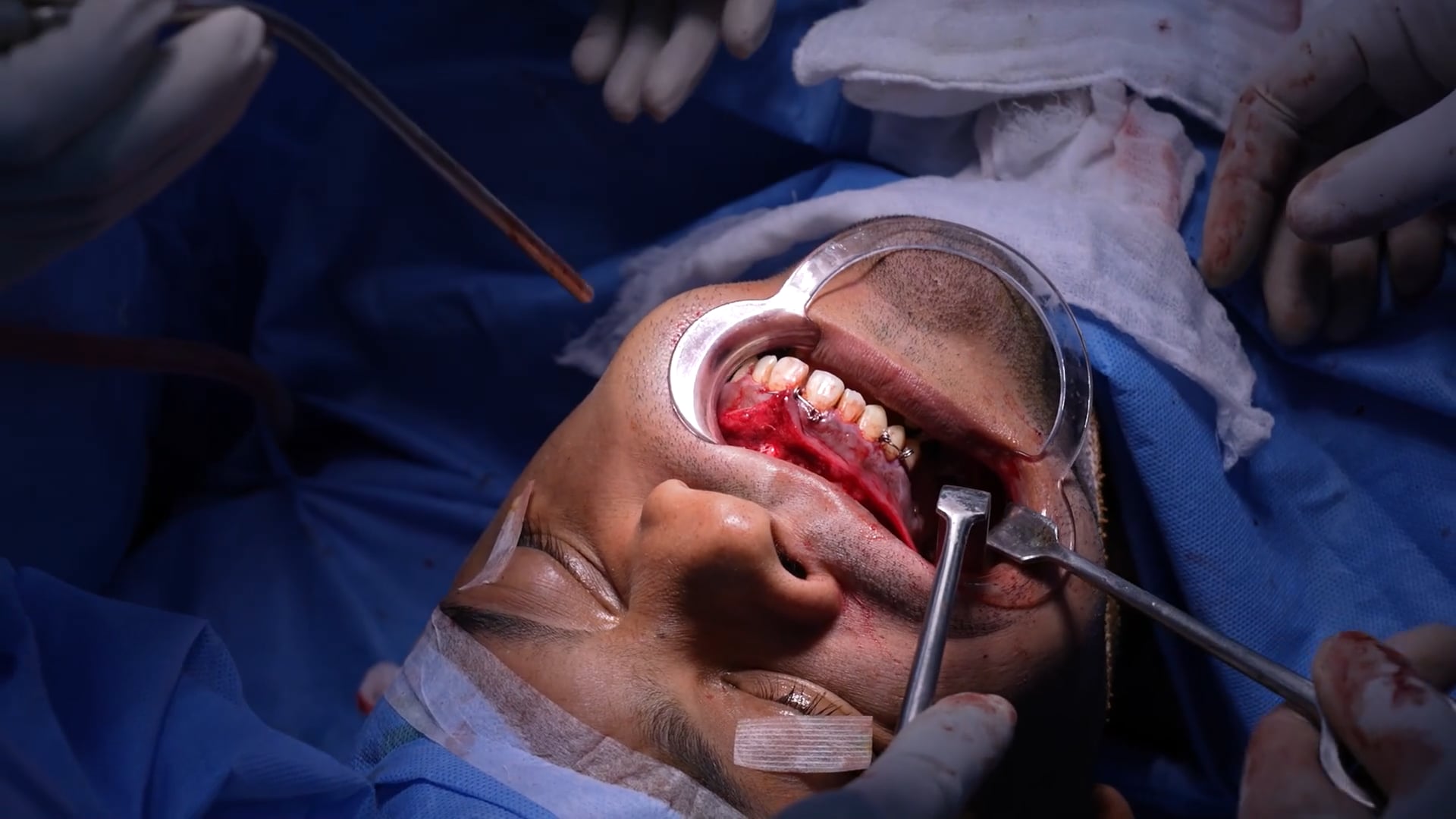 Bijaw Surgery