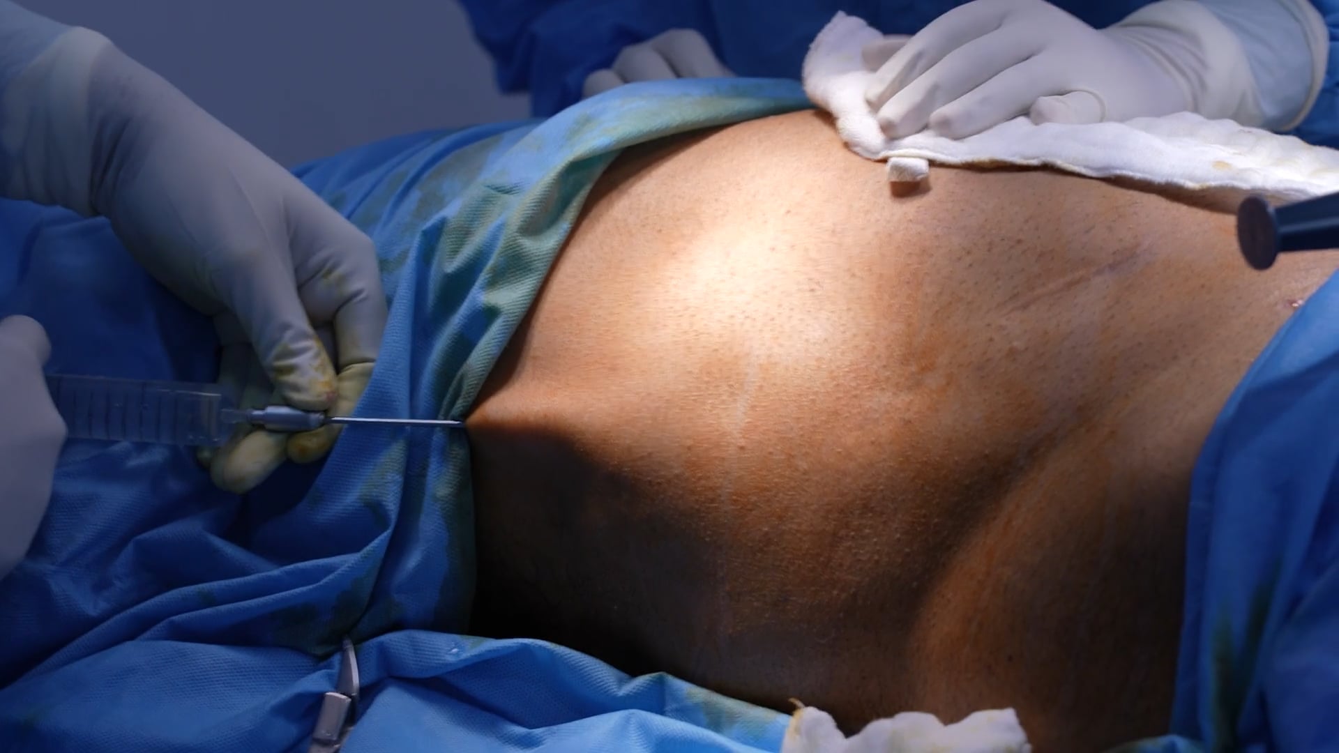 Lipo Suction Male