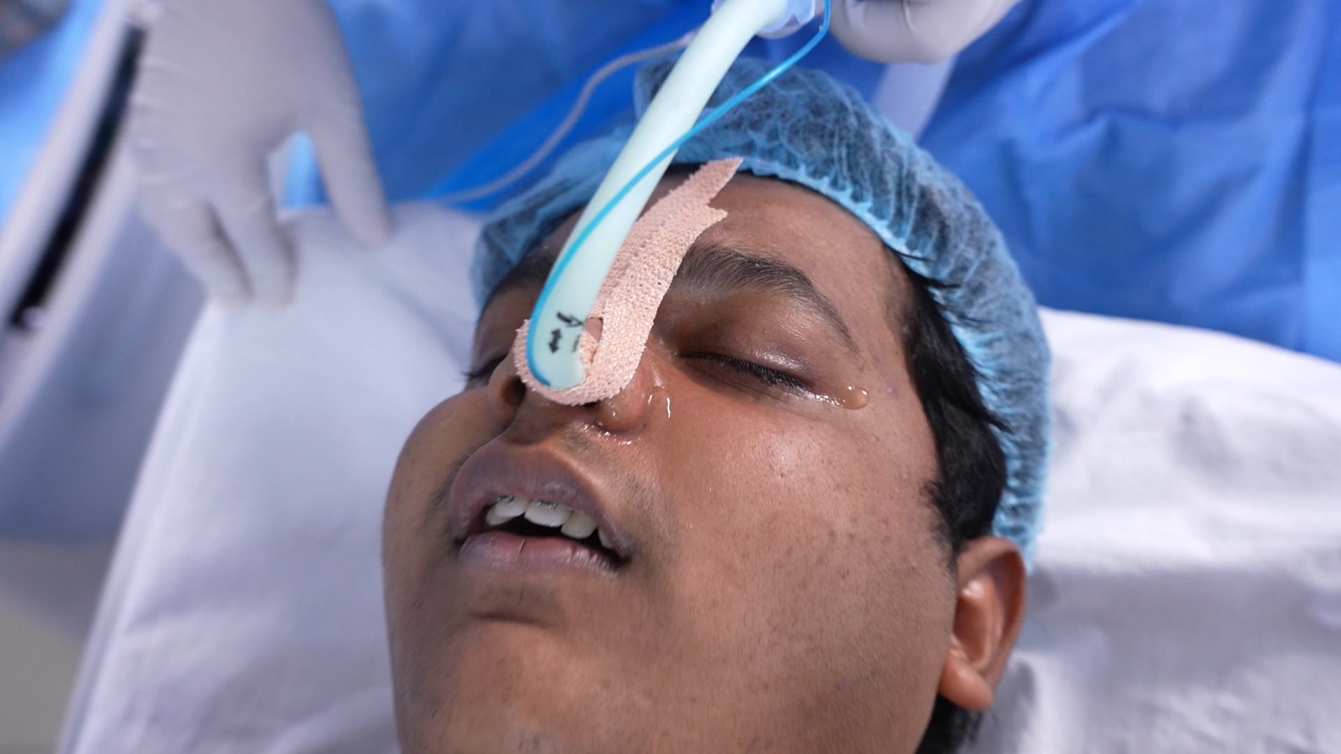 Chin augmentation Surgery