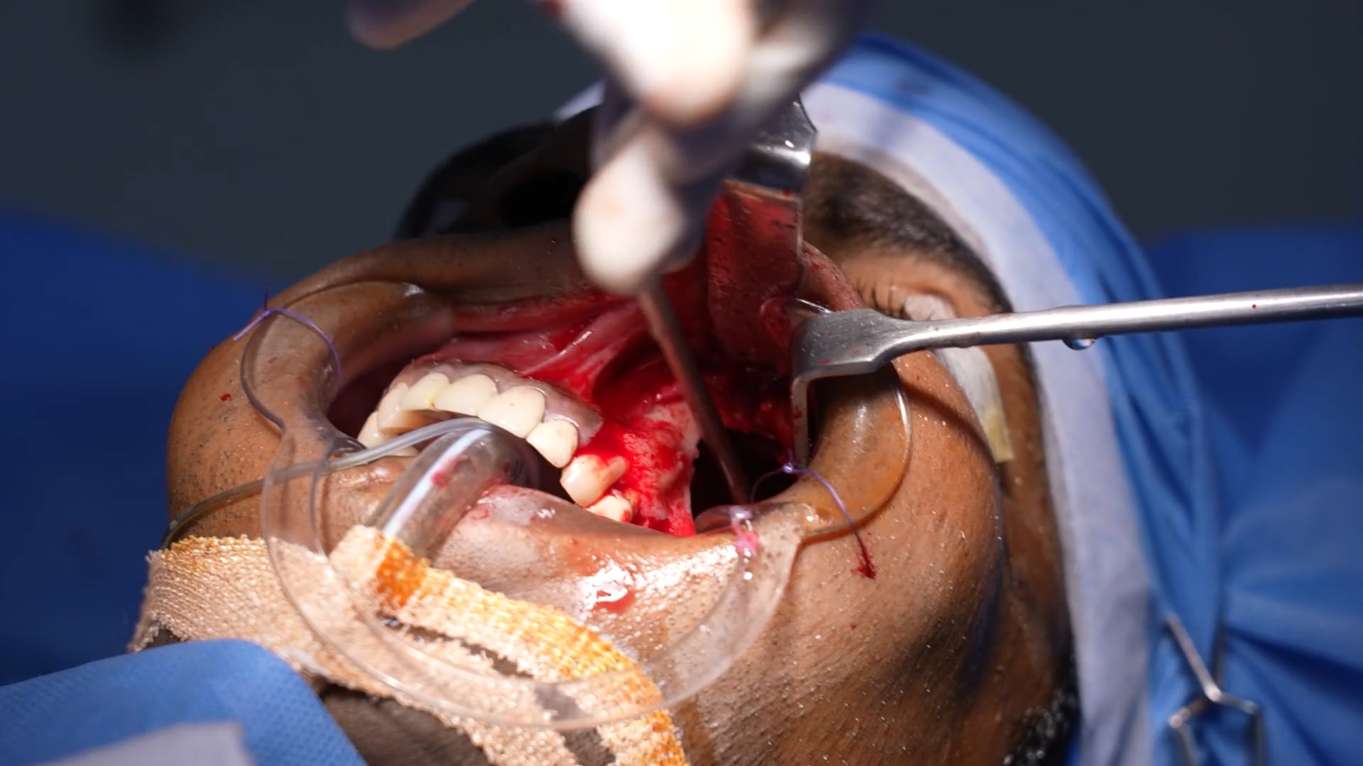 Sinus Surgery