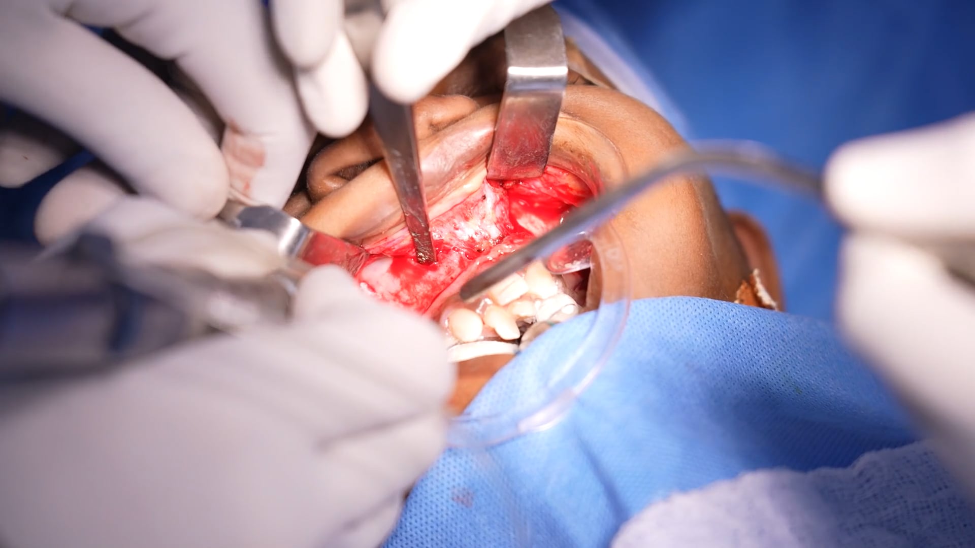 Young Girl Upper Jaw Surgery