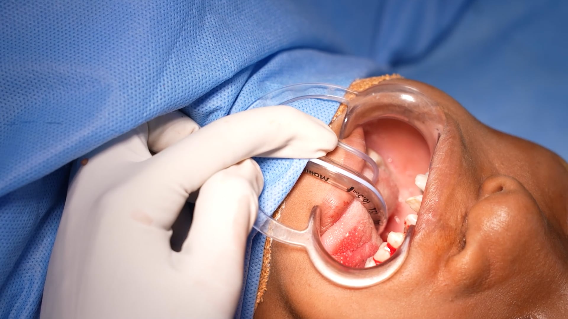 16 Years Old Kid Cleft Lip Palate