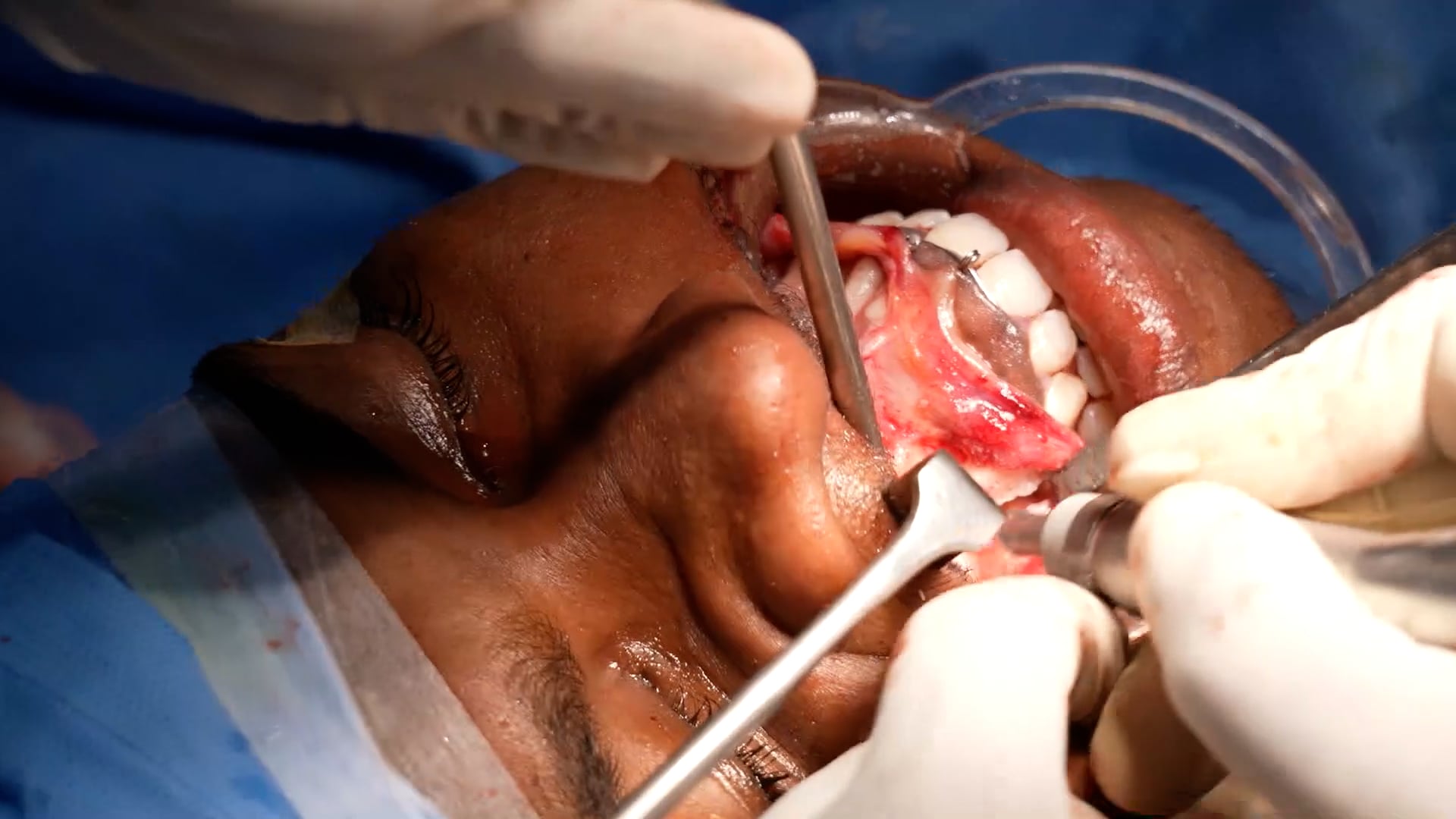Bimaxillary surgery- Facemakeover surgery