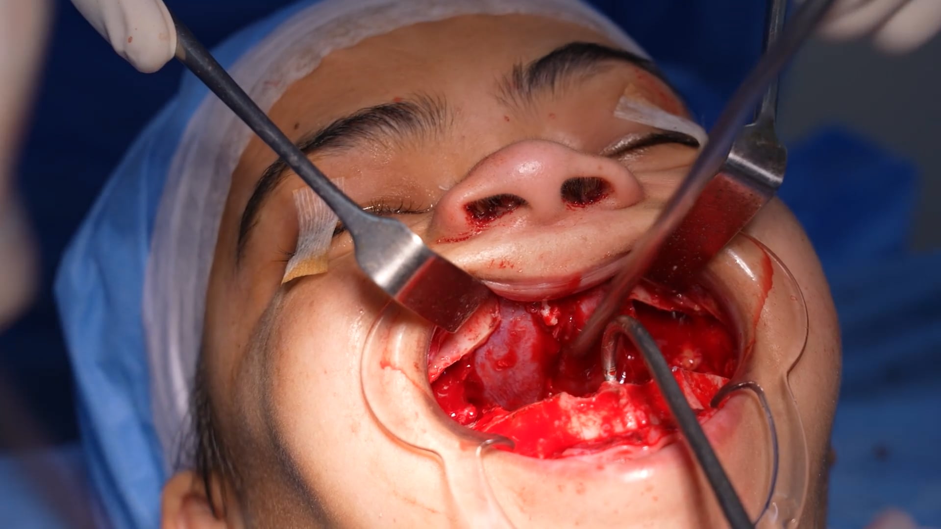 Bijaw Surgery Young Lady