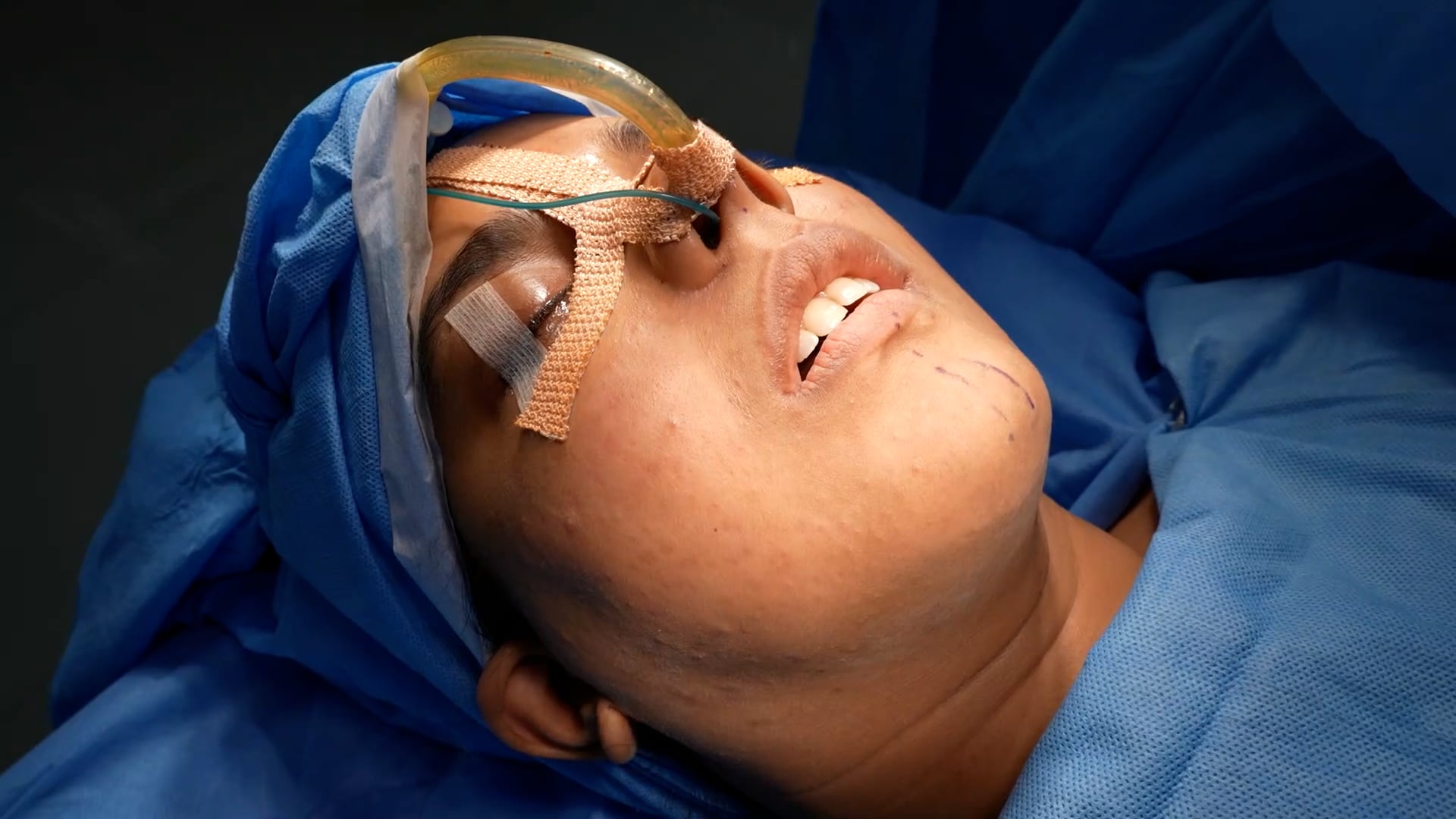 Genioplasty surgery patient with facial asymmetry