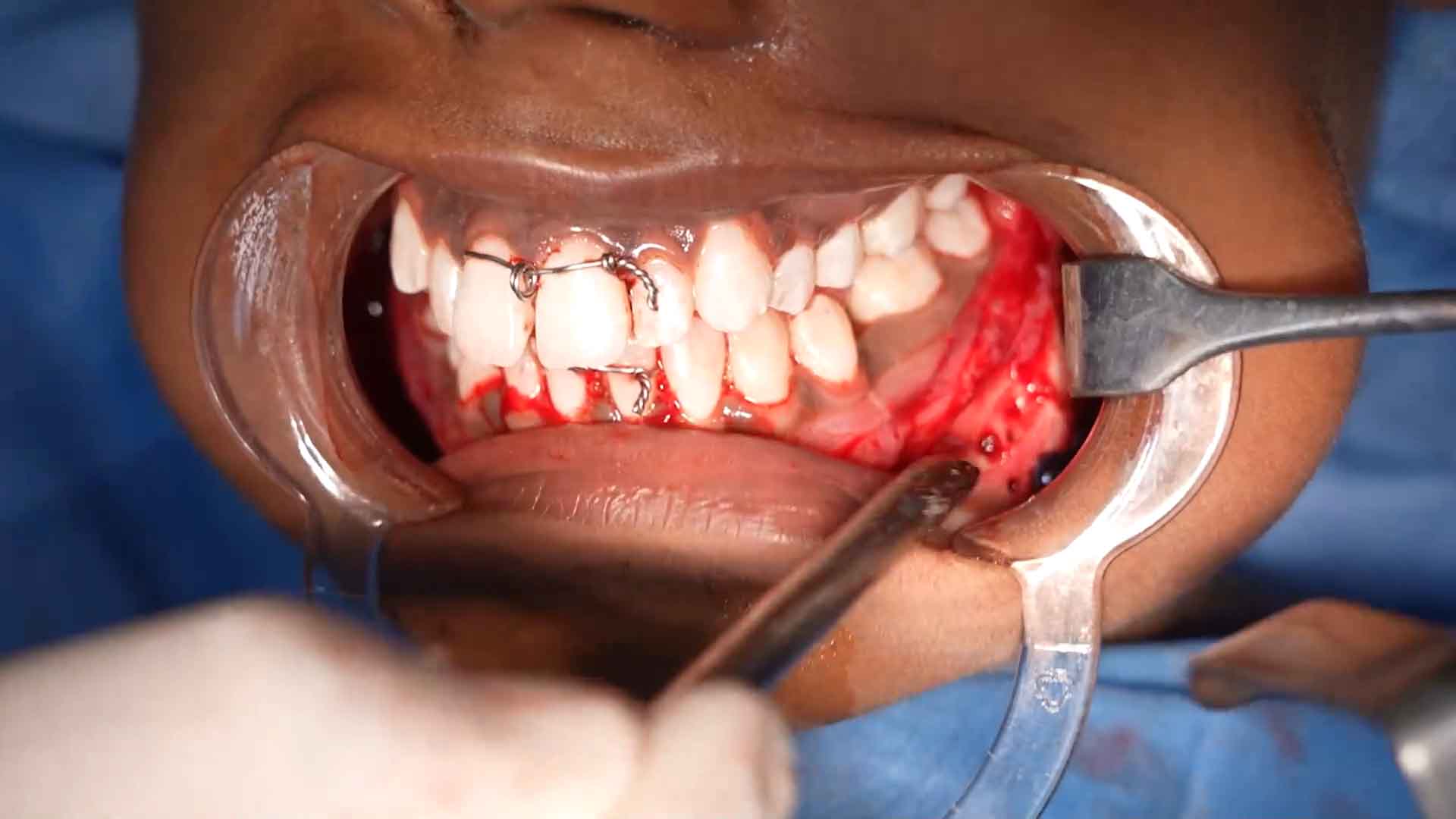 Revision BSSO surgery