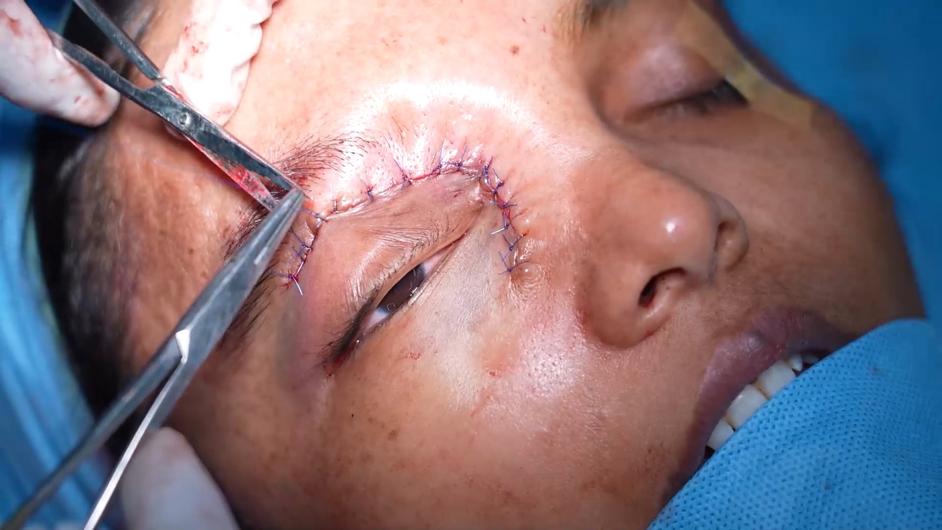 Neurofibroma Tumor Removal