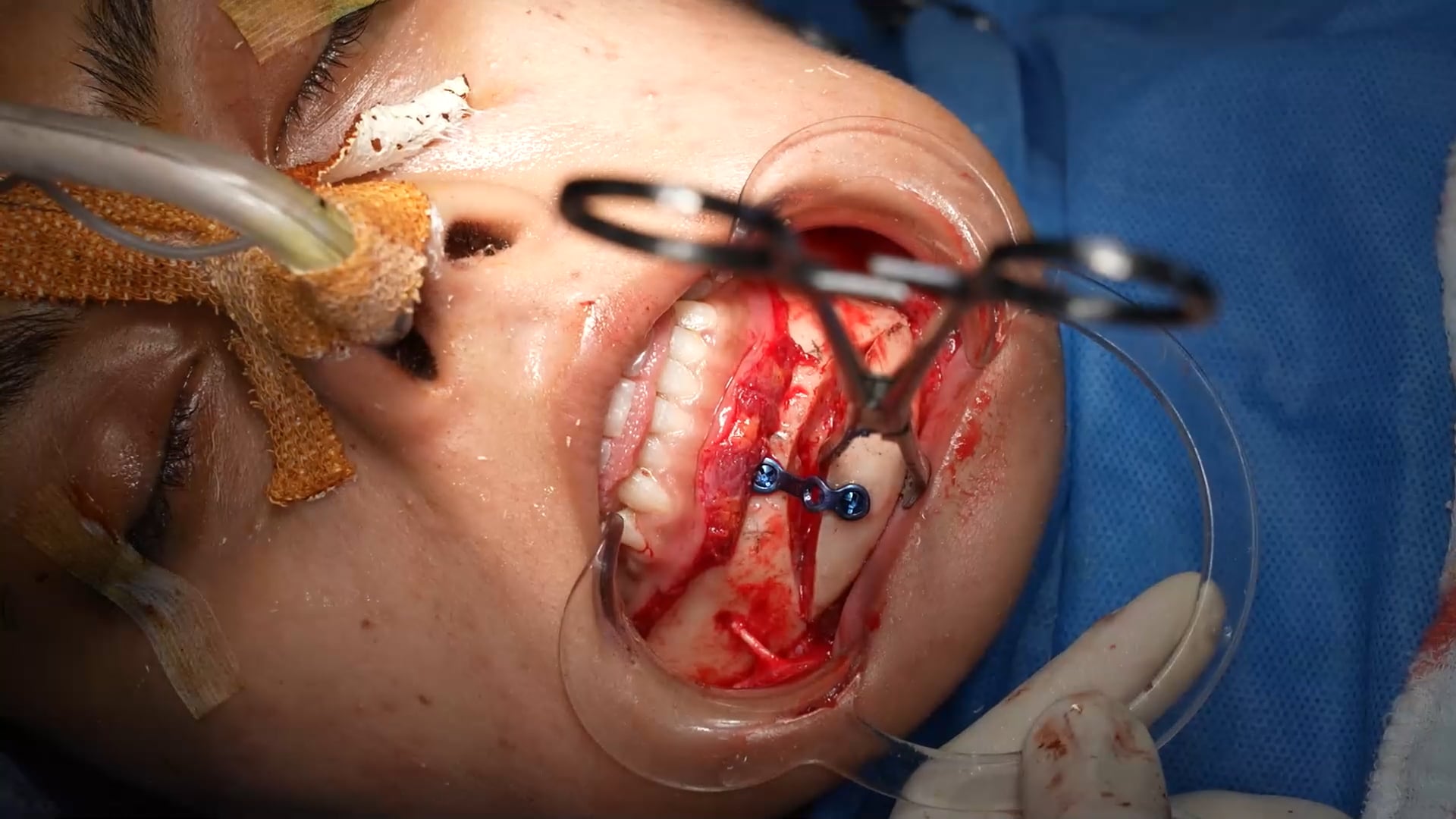 Genioplasty Complete Surgery Female